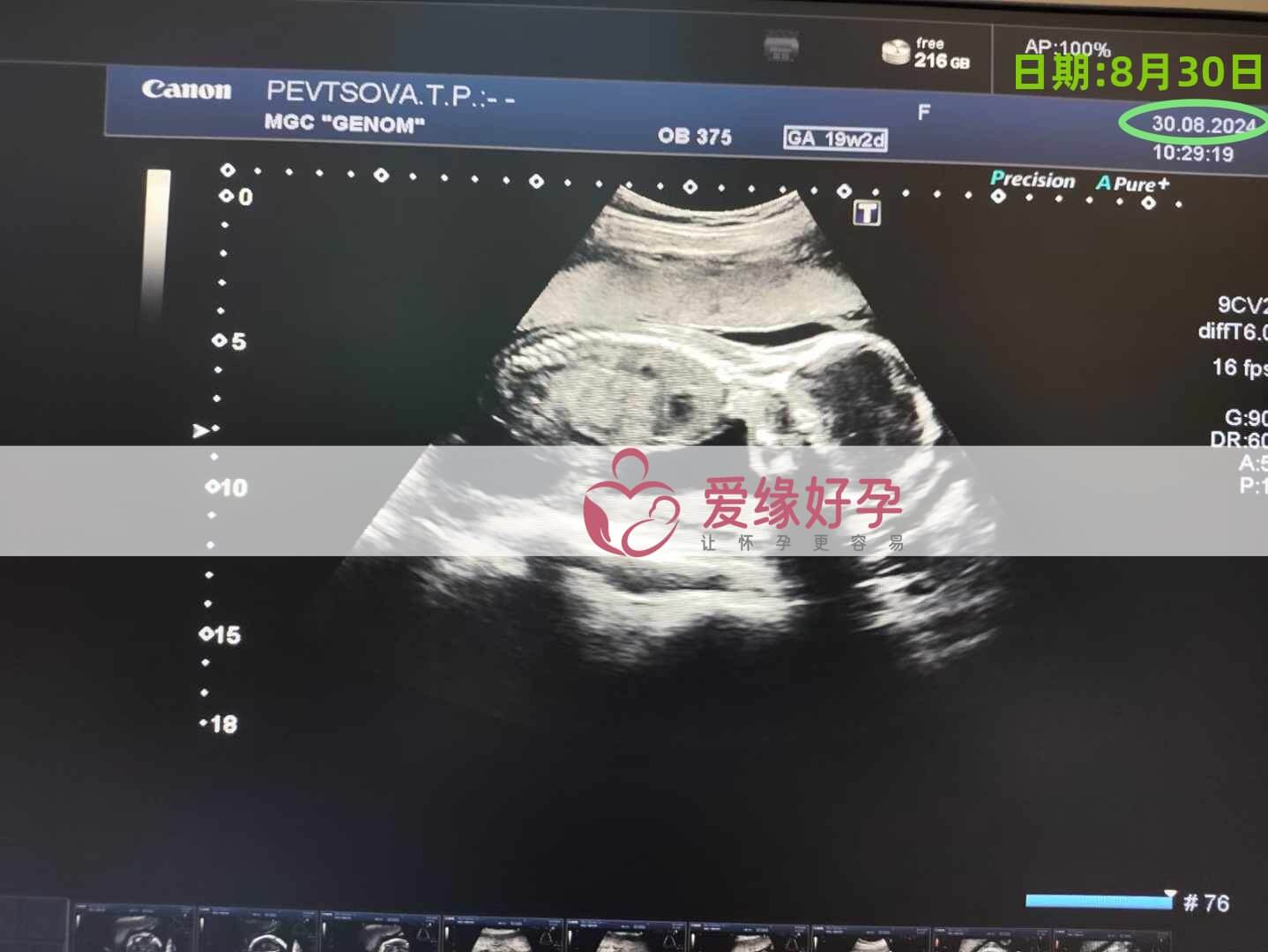 乌克兰恩泽ENZE爱心妈妈孕20周产检顺利通过！
