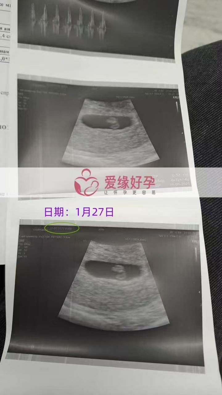 格鲁吉亚试管婴儿助孕爱心使者6周产检顺利通过