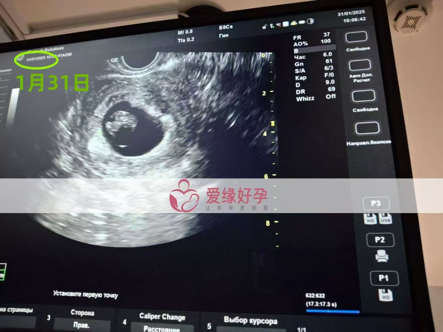​乌克兰试管婴儿助孕爱心使者8周产检顺利通过