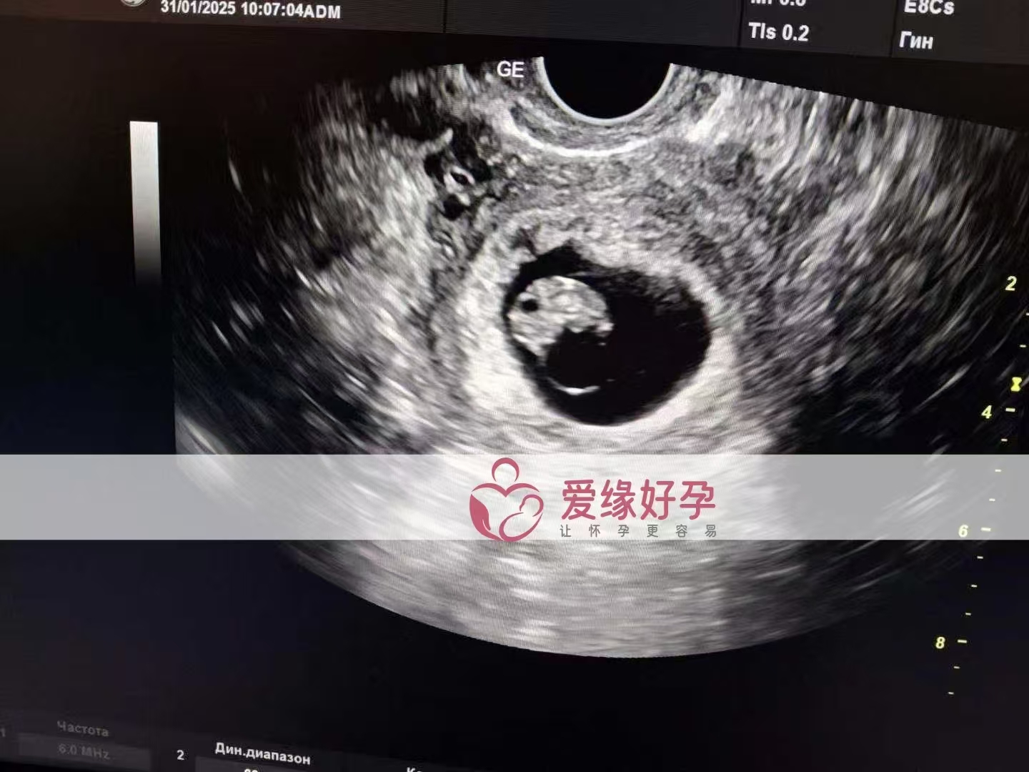 ​乌克兰试管婴儿助孕爱心使者8周产检顺利通过