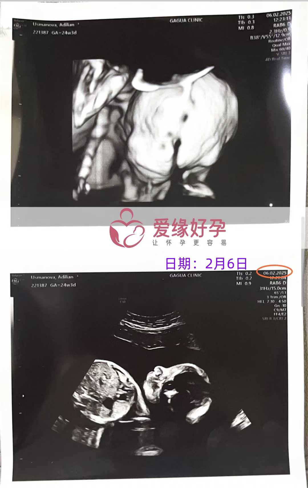 格鲁吉亚试管婴儿助孕爱心使者25周产检顺利通过