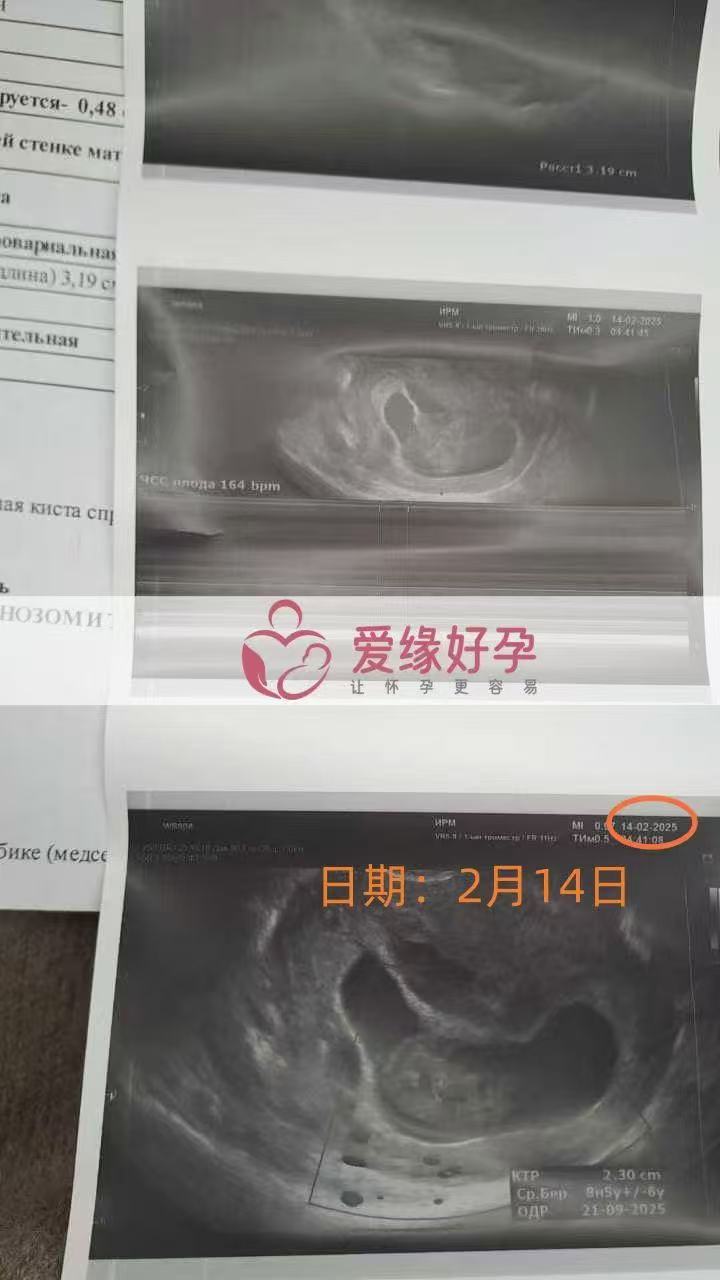 格鲁吉亚试管婴儿助孕爱心使者14周产检结果安好