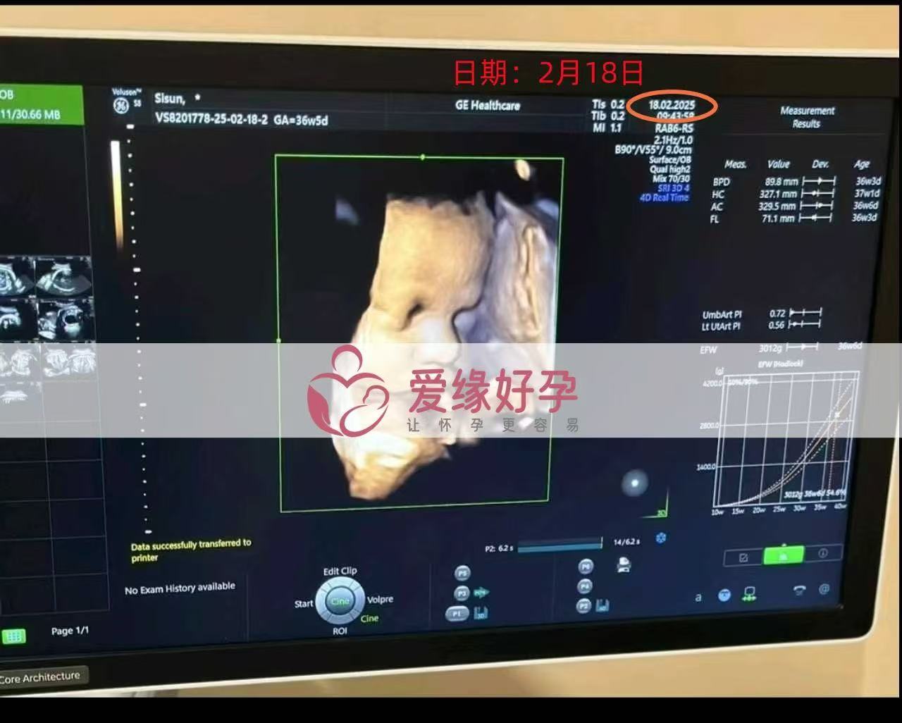 乌克兰试管婴儿助孕爱心使者36周产检顺利，孕期接近尾声