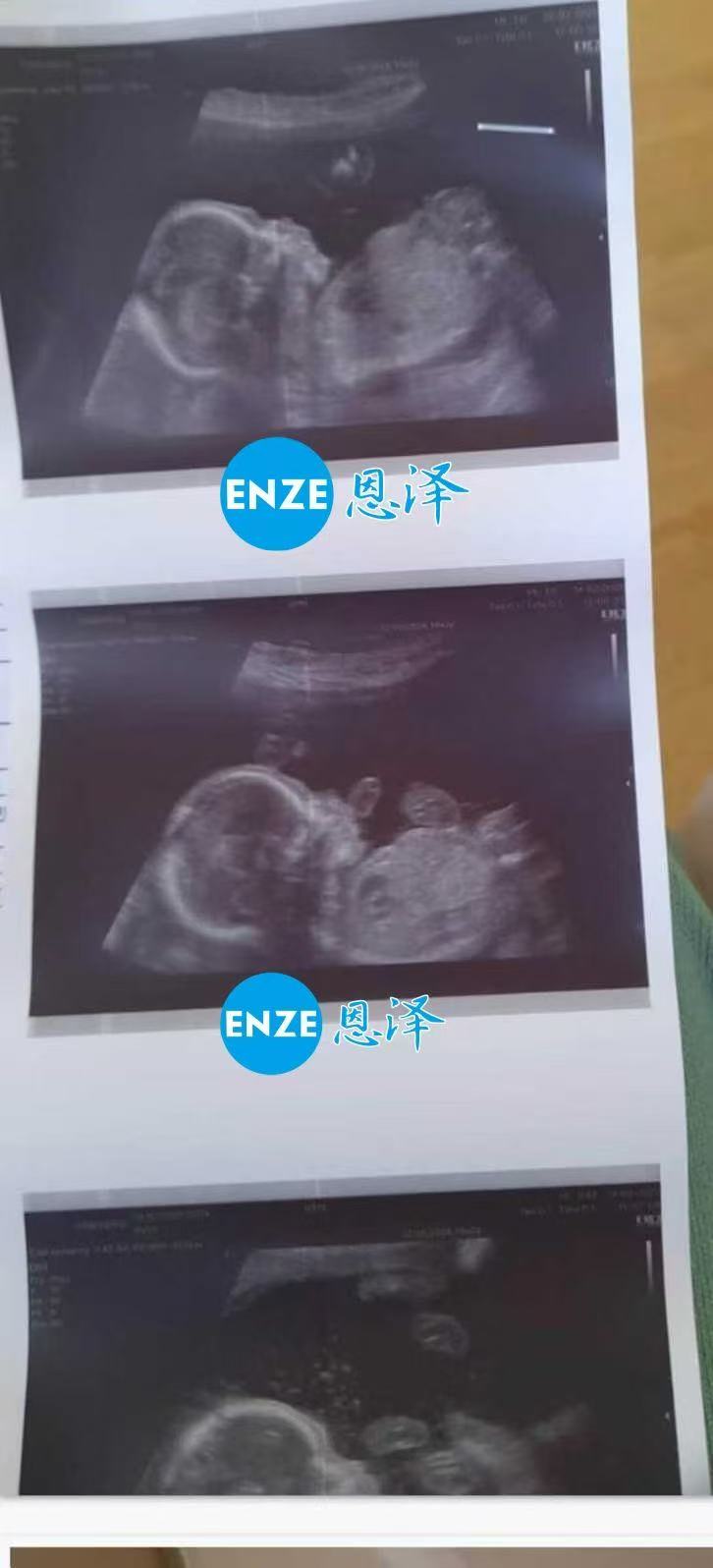 格鲁吉亚试管婴儿助孕爱心使者19周产检顺利通过
