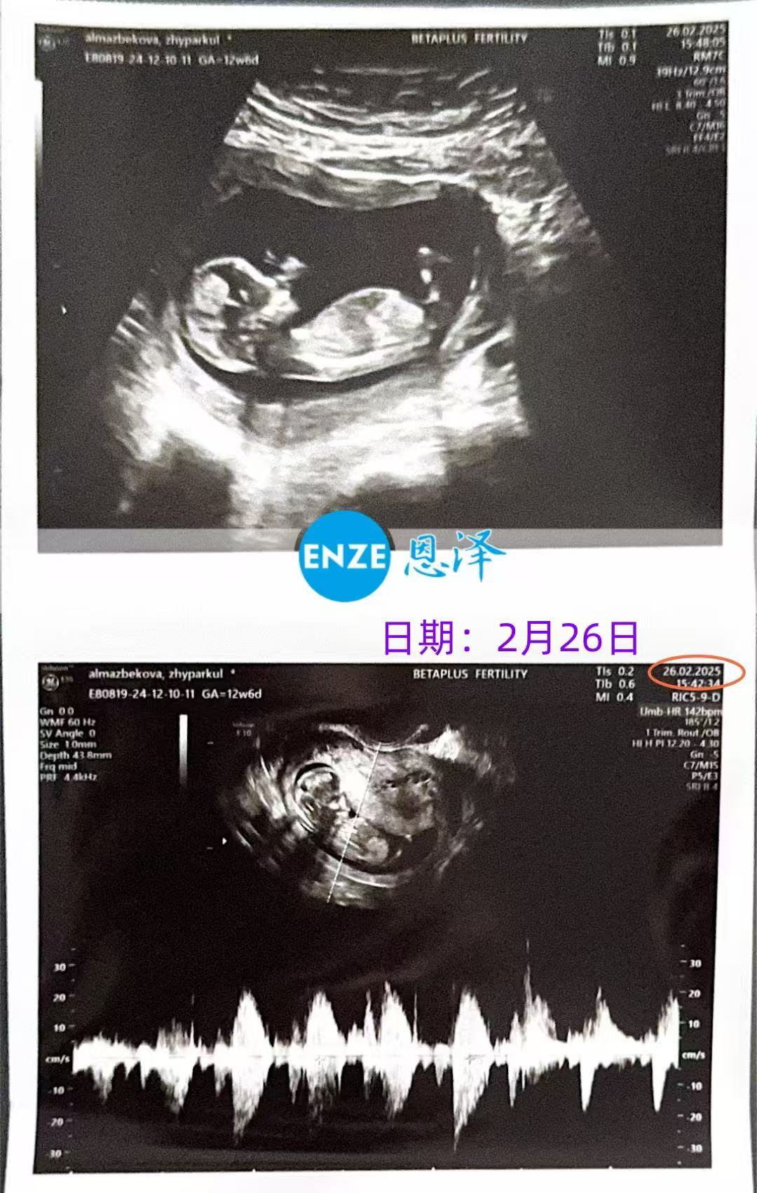 格鲁吉亚试管婴儿助孕爱心使者12周产检通过，平稳度过风险期