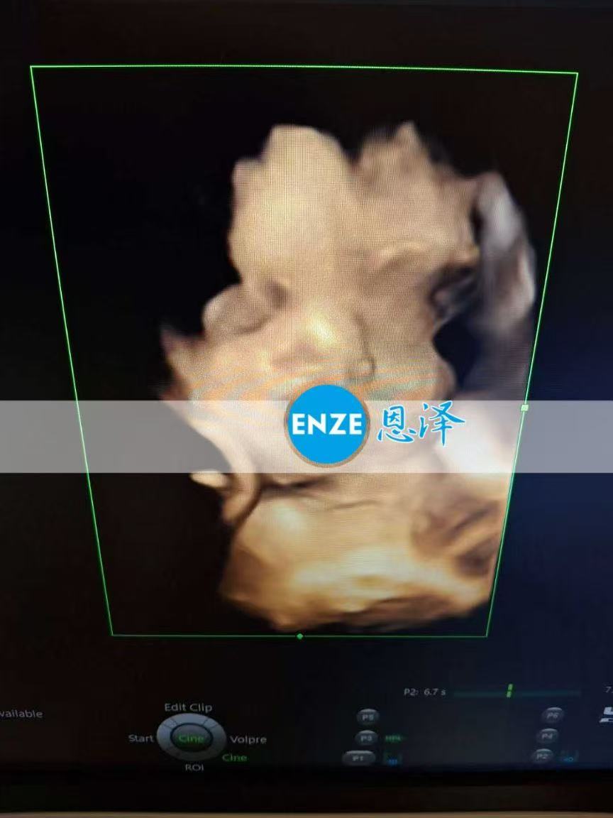 格鲁吉亚试管婴儿助孕爱心使者32周产检顺利通过