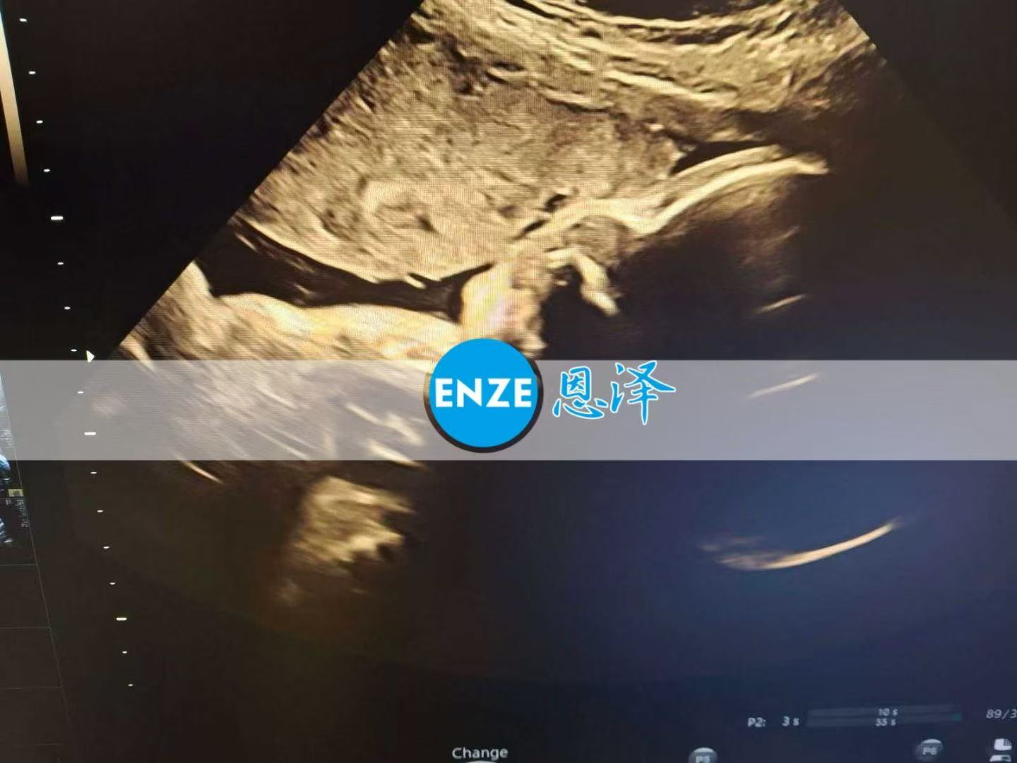 格鲁吉亚试管婴儿助孕爱心使者32周产检顺利通过