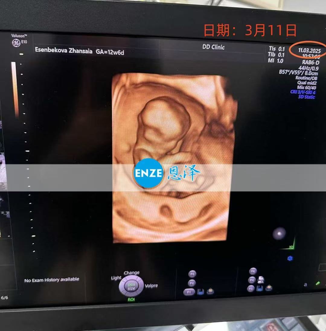 格鲁吉亚试管婴儿助孕爱心使者通过13周产检，正式步入稳定期