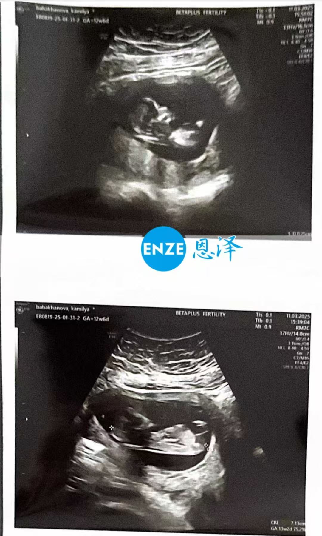 格鲁吉亚试管婴儿助孕爱心使者通过13周产检，正式度过风险期