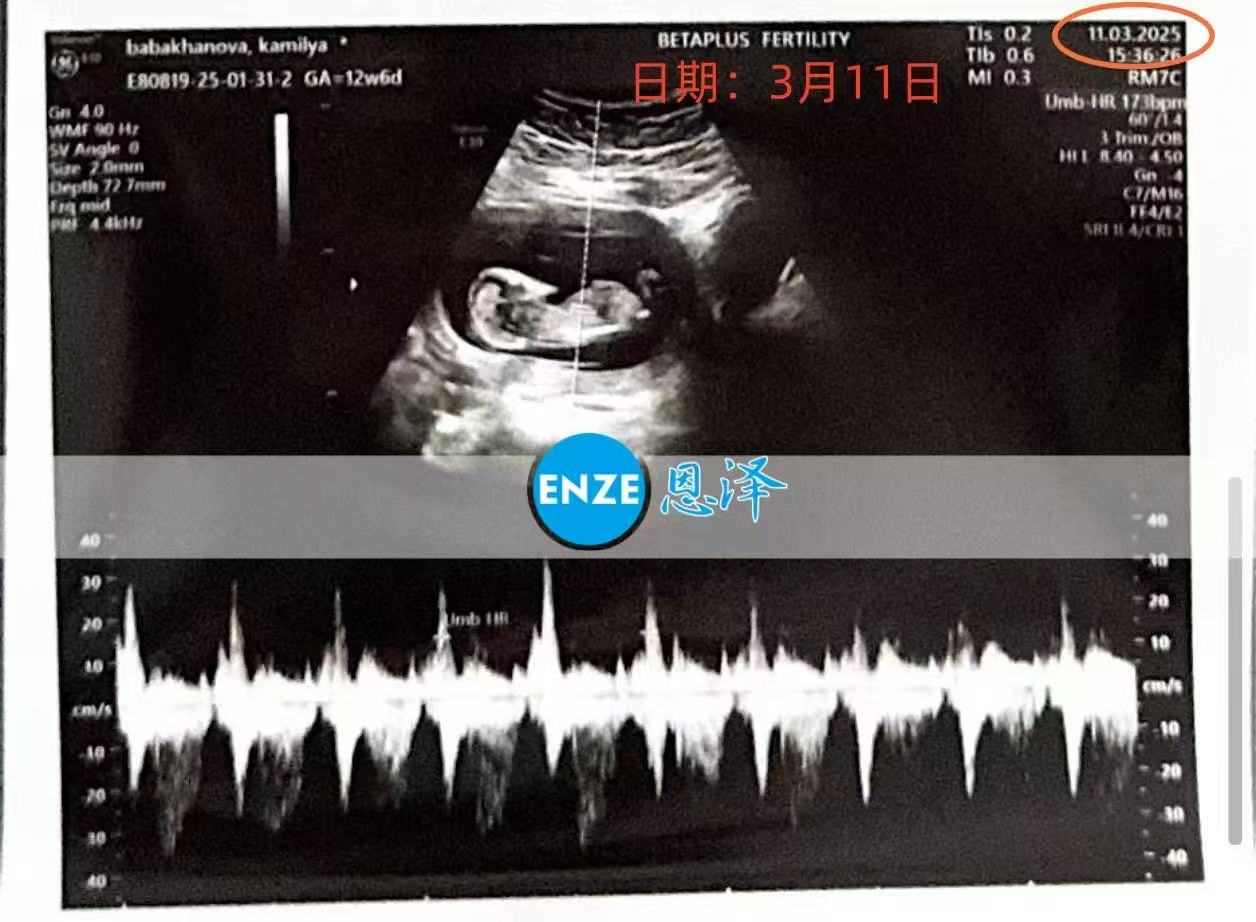 格鲁吉亚试管婴儿助孕爱心使者通过13周产检，正式度过风险期