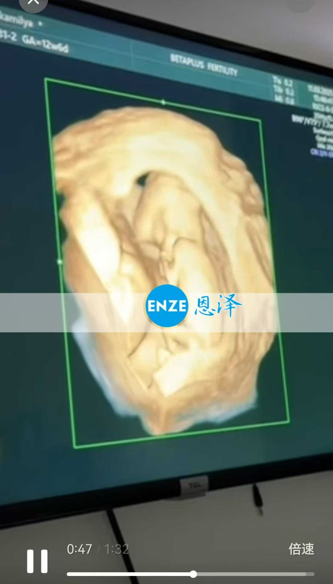 格鲁吉亚试管婴儿助孕爱心使者通过13周产检，正式度过风险期