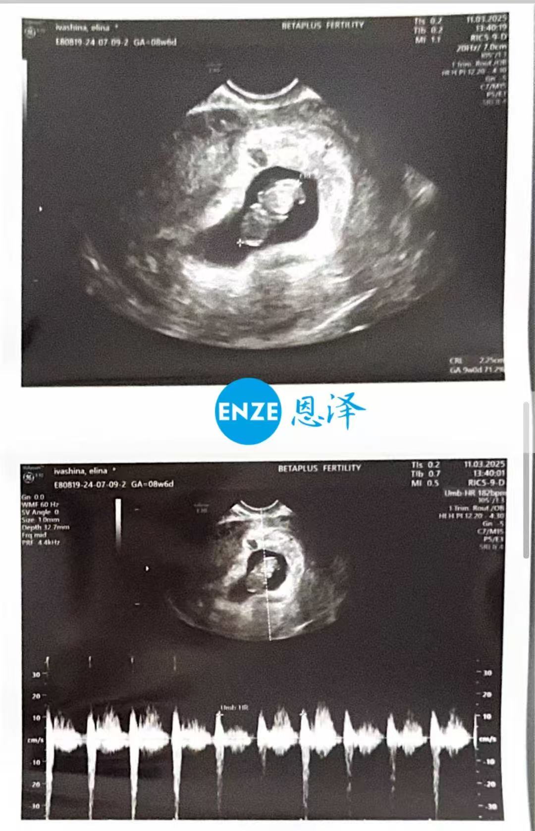 格鲁吉亚试管婴儿助孕爱心使者8周产检顺利通过