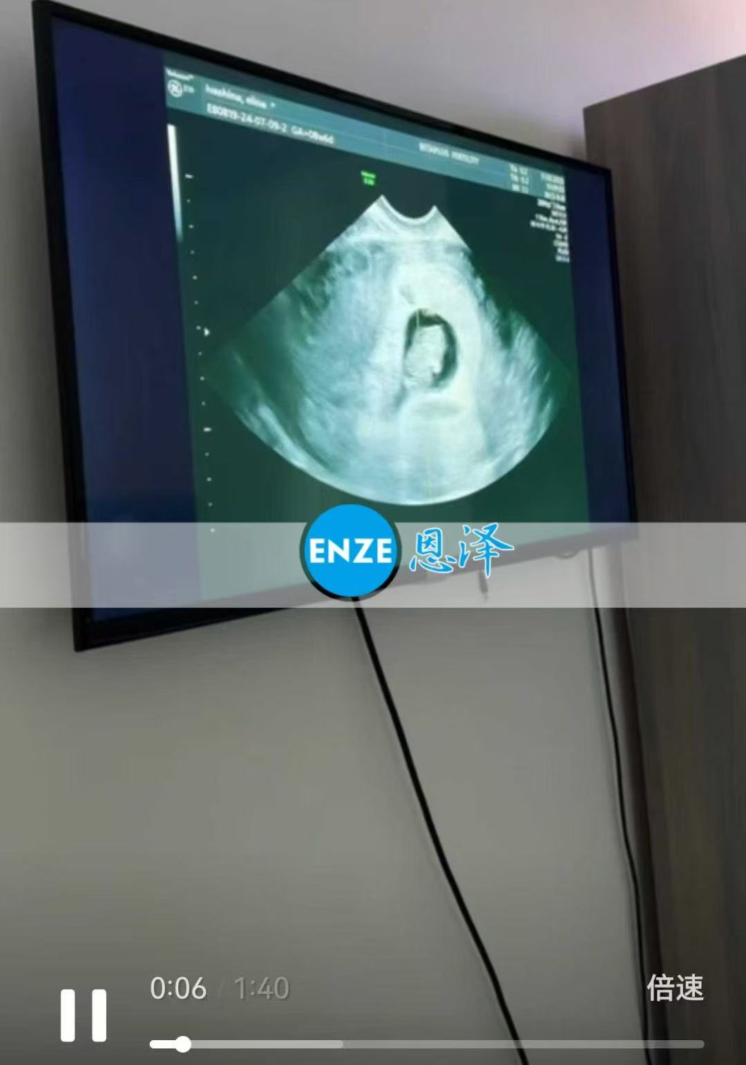 格鲁吉亚试管婴儿助孕爱心使者8周产检顺利通过