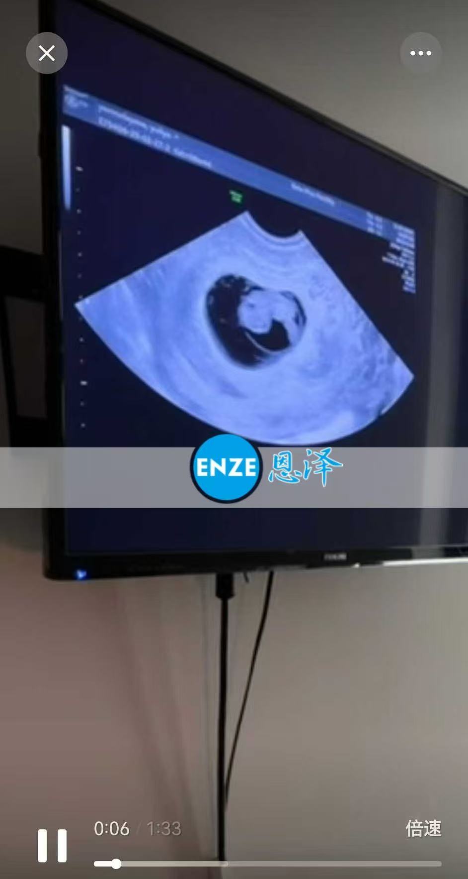 格鲁吉亚试管婴儿助孕爱心使者顺利通过8周产检