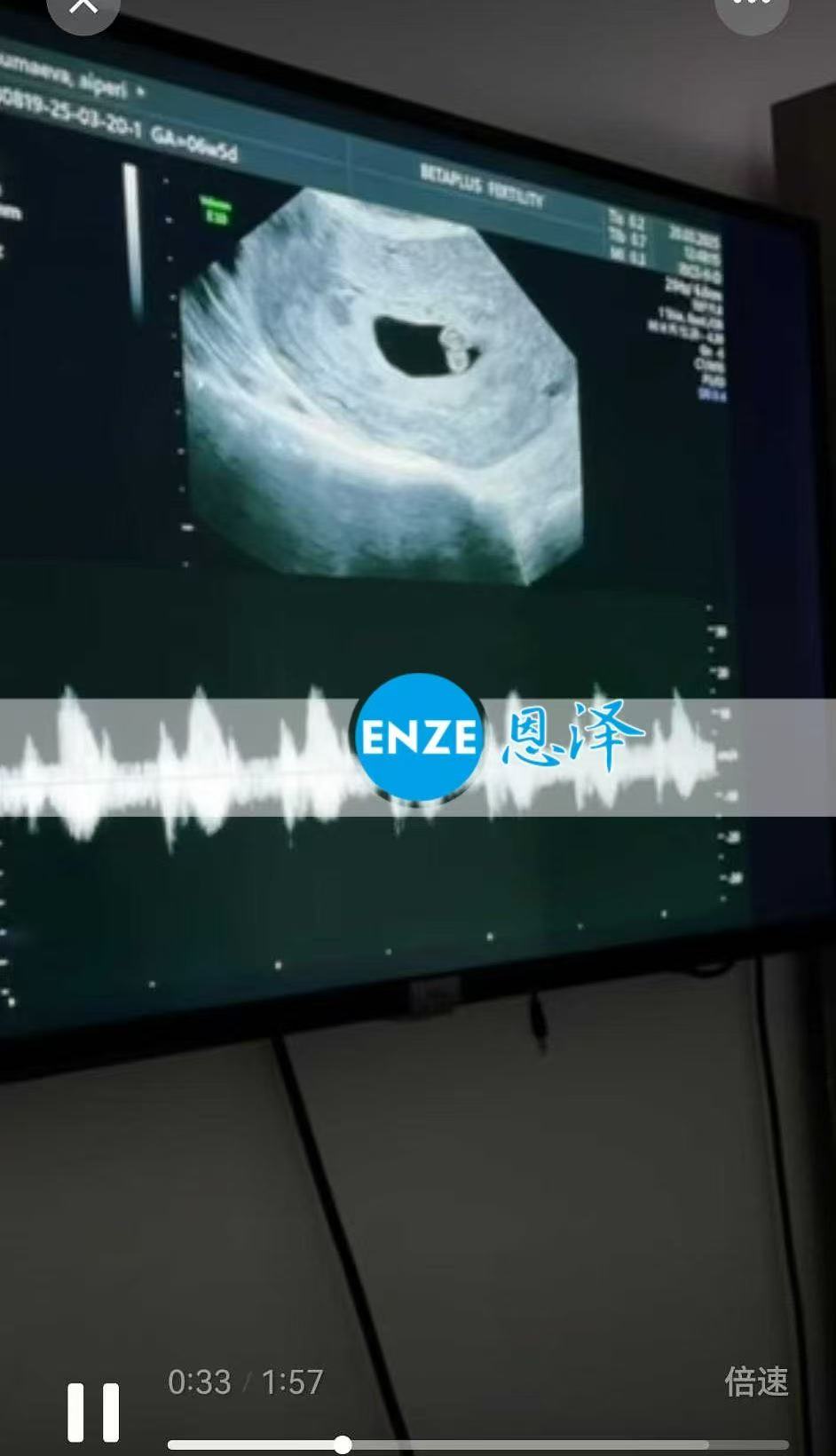 格鲁吉亚试管婴儿助孕爱心使者顺利通过6周产检