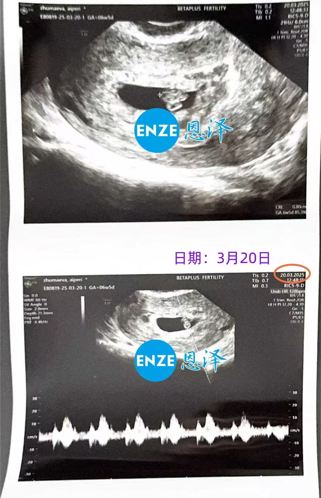 格鲁吉亚试管婴儿助孕爱心使者顺利通过6周产检