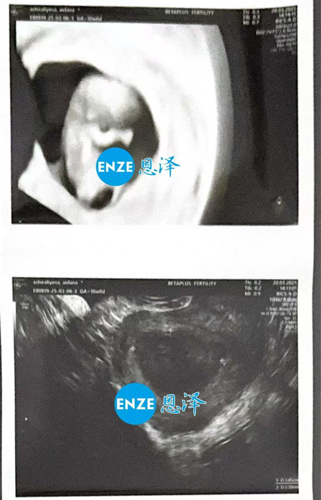 格鲁吉亚试管婴儿助孕爱心使者10周产检顺利过关