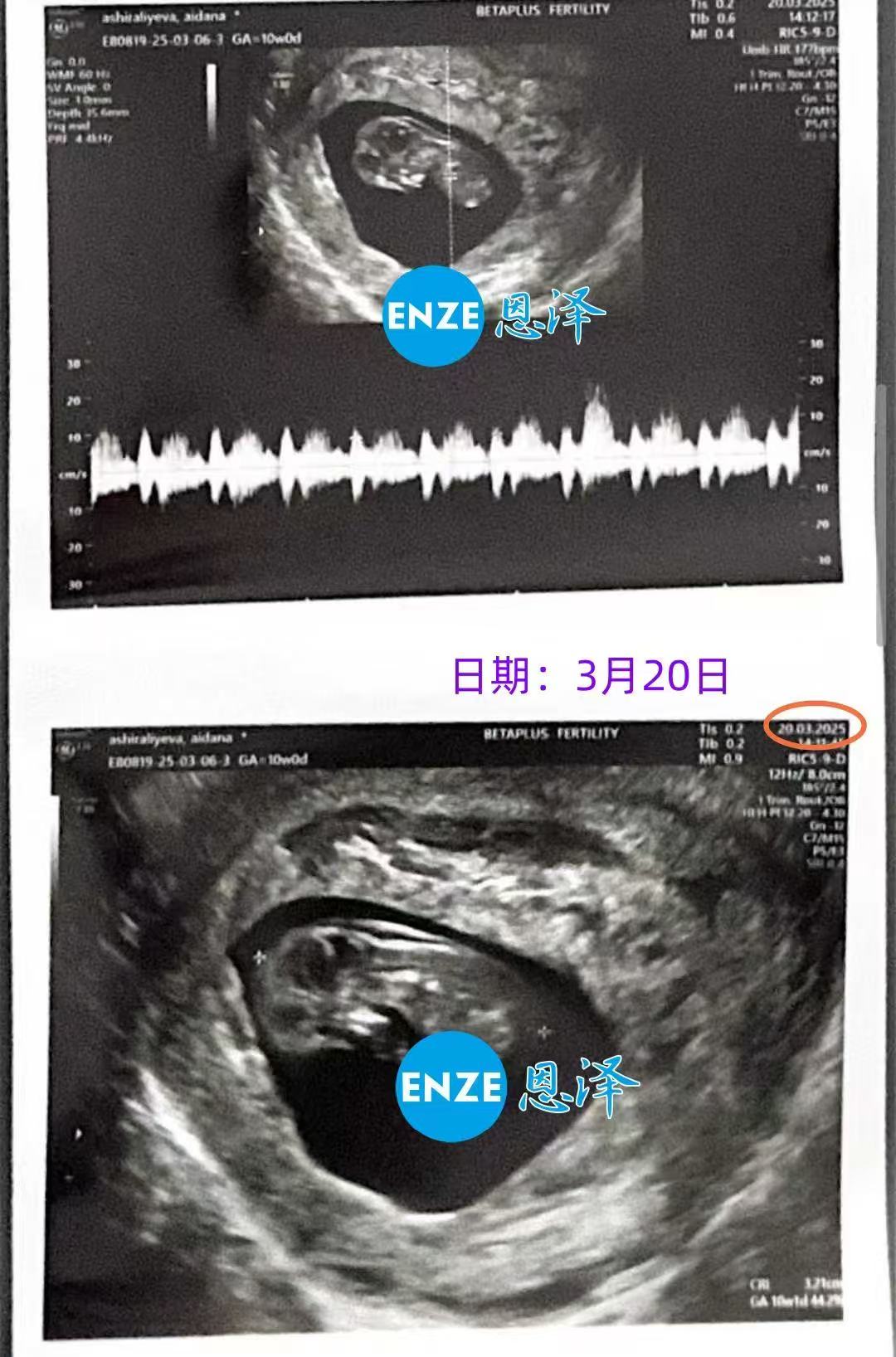 格鲁吉亚试管婴儿助孕爱心使者10周产检顺利过关