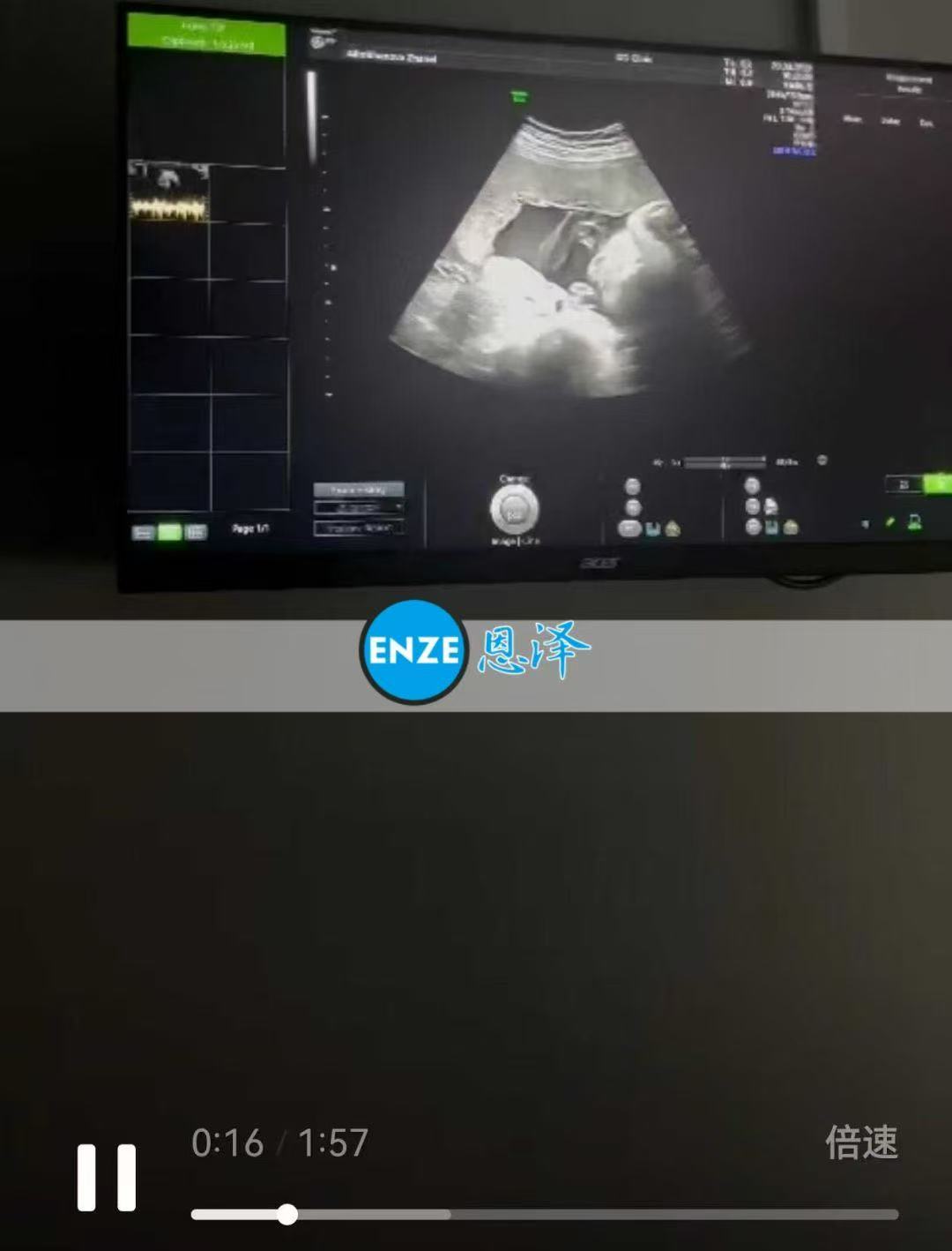 格鲁吉亚试管婴儿助孕爱心使者30周产检顺利通过