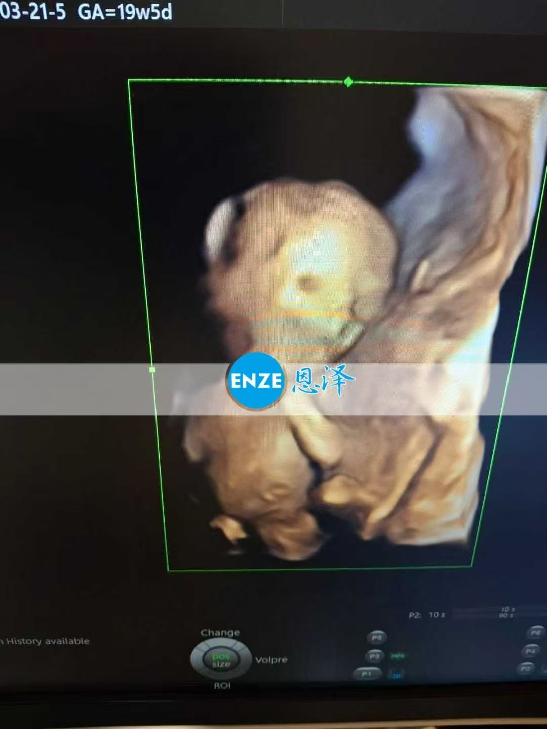 乌克兰试管婴儿助孕爱心使者19周产检顺利过关