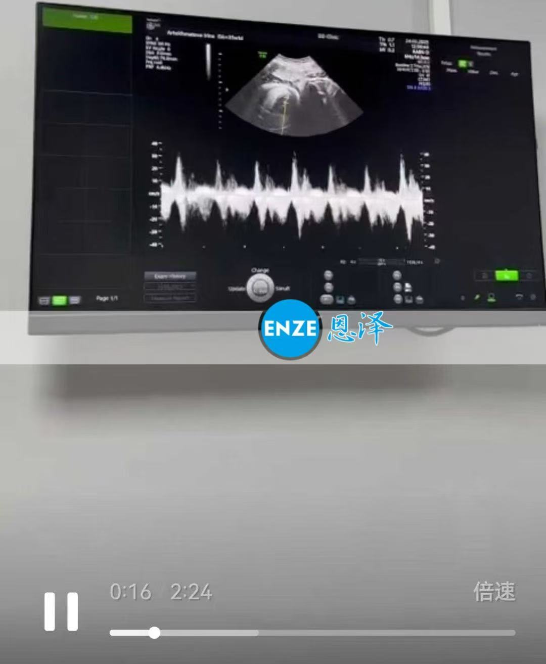 格鲁吉亚试管婴儿助孕爱心使者即将迎接龙凤胎降生
