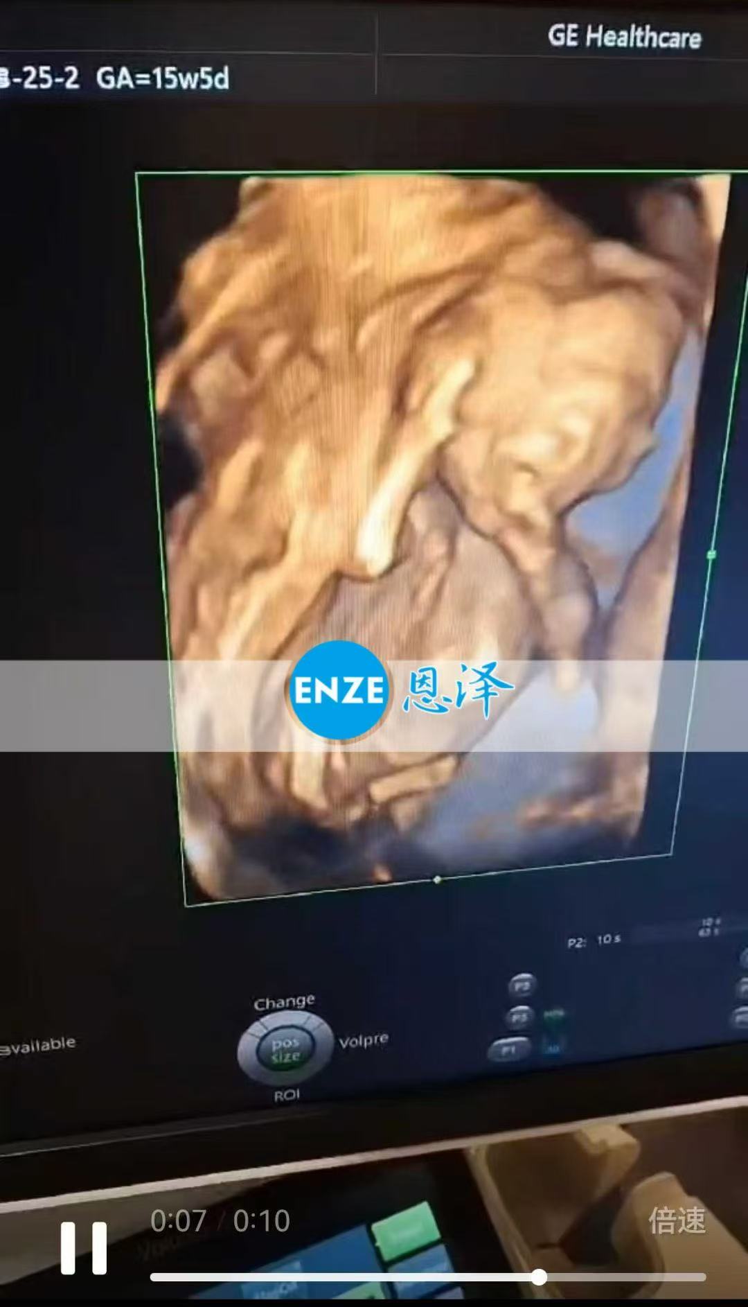 乌克兰试管婴儿助孕爱心使者顺利通过16周产检