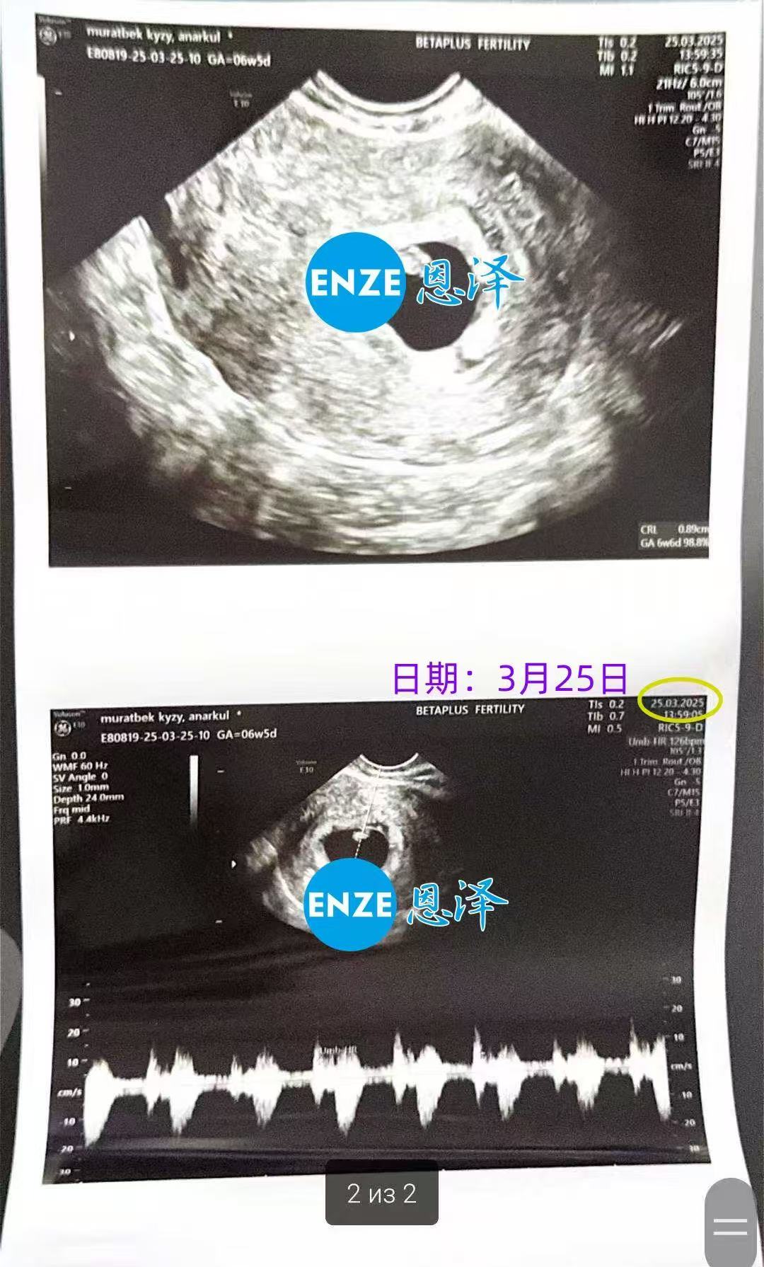 格鲁吉亚试管婴儿助孕爱心使者6周产检顺利通过