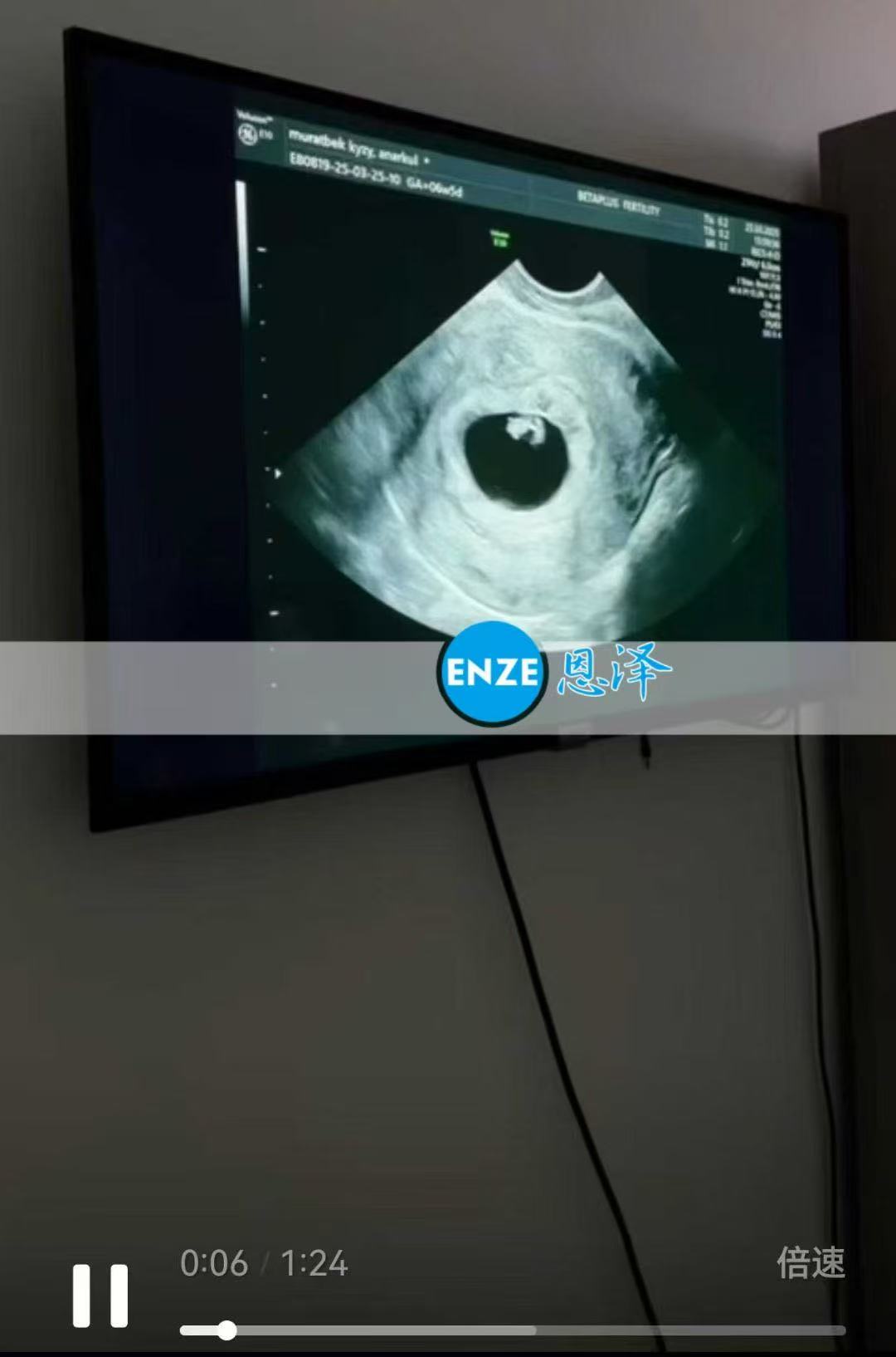 格鲁吉亚试管婴儿助孕爱心使者6周产检顺利通过