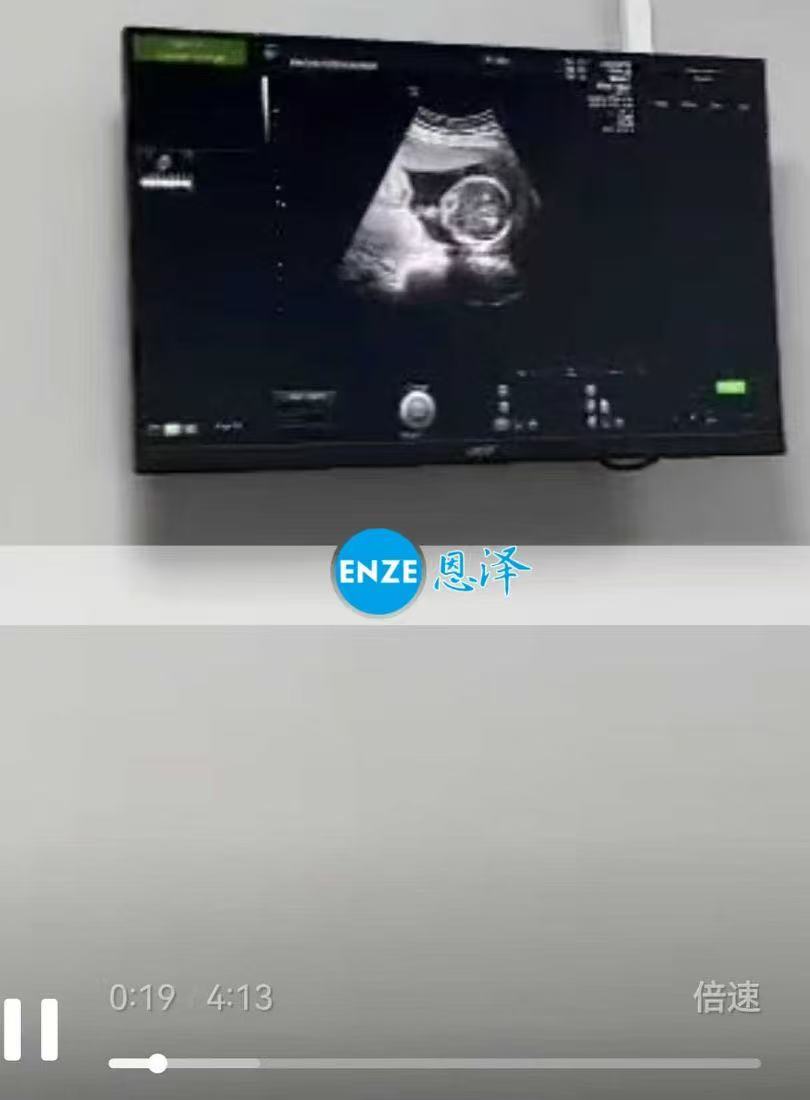 格鲁吉亚试管婴儿助孕爱心使者19周产检顺利过关