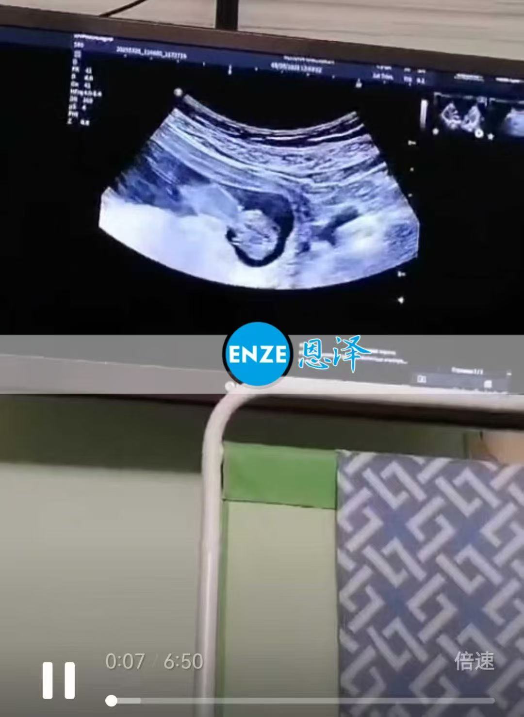 格鲁吉亚试管婴儿助孕爱心使者11周产检顺利通过