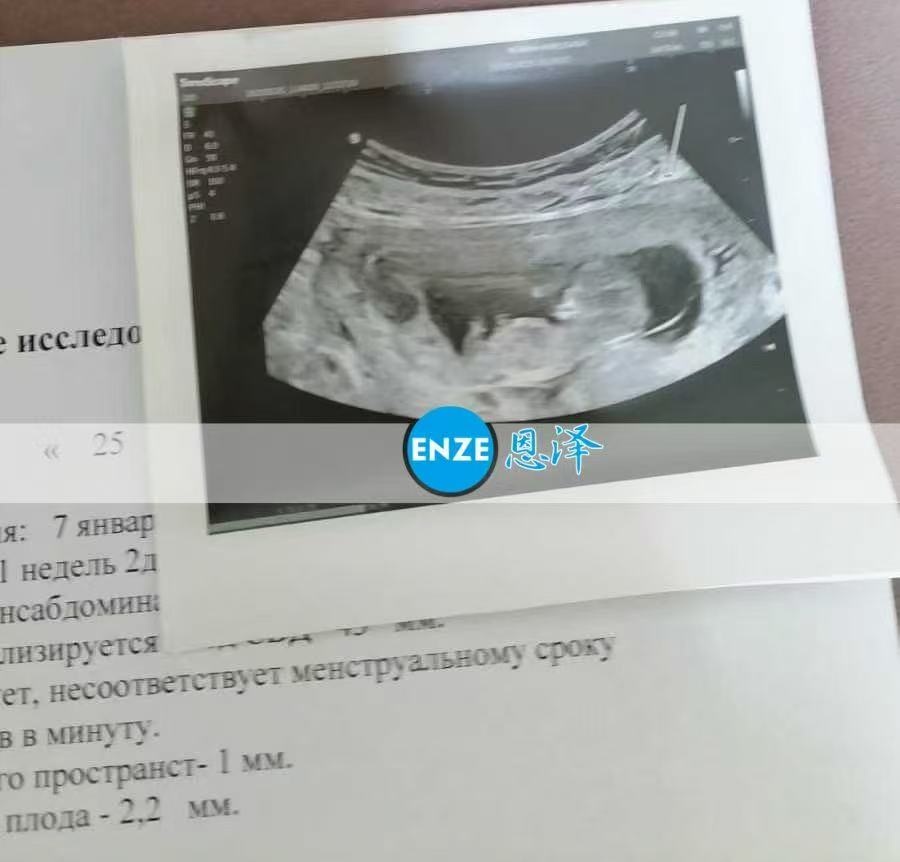 格鲁吉亚试管婴儿助孕爱心使者11周产检顺利通过