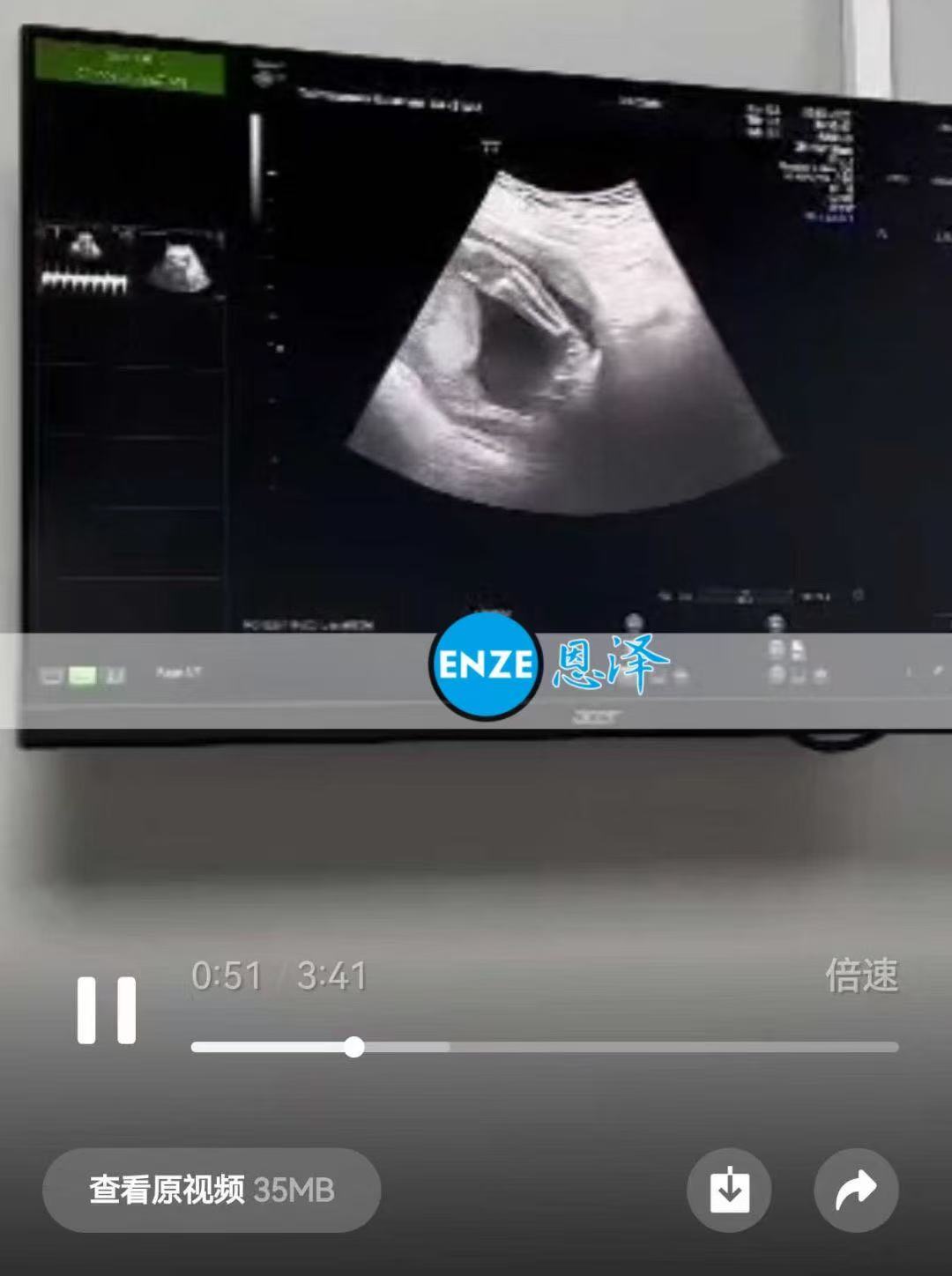 格鲁吉亚试管婴儿助孕爱心使者20周产检顺利通过