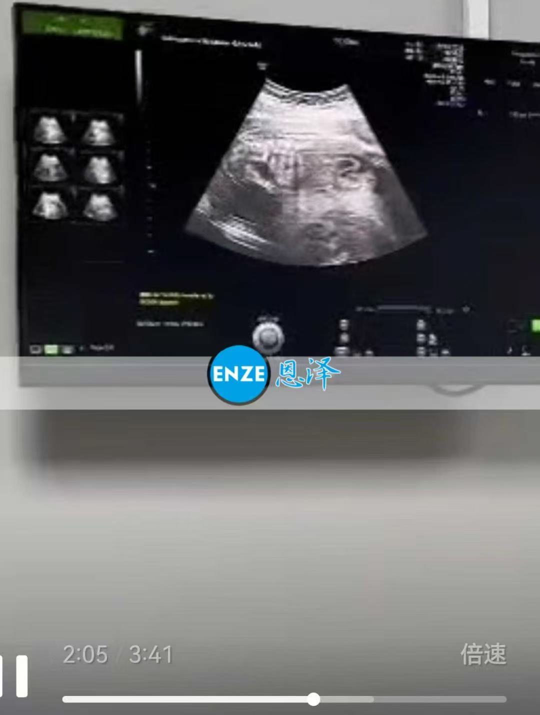 格鲁吉亚试管婴儿助孕爱心使者20周产检顺利通过