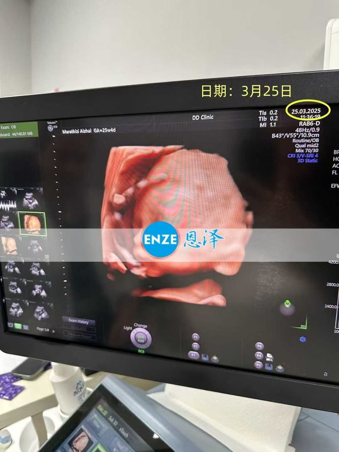 格鲁吉亚试管婴儿助孕爱心使者26周产检顺利通过