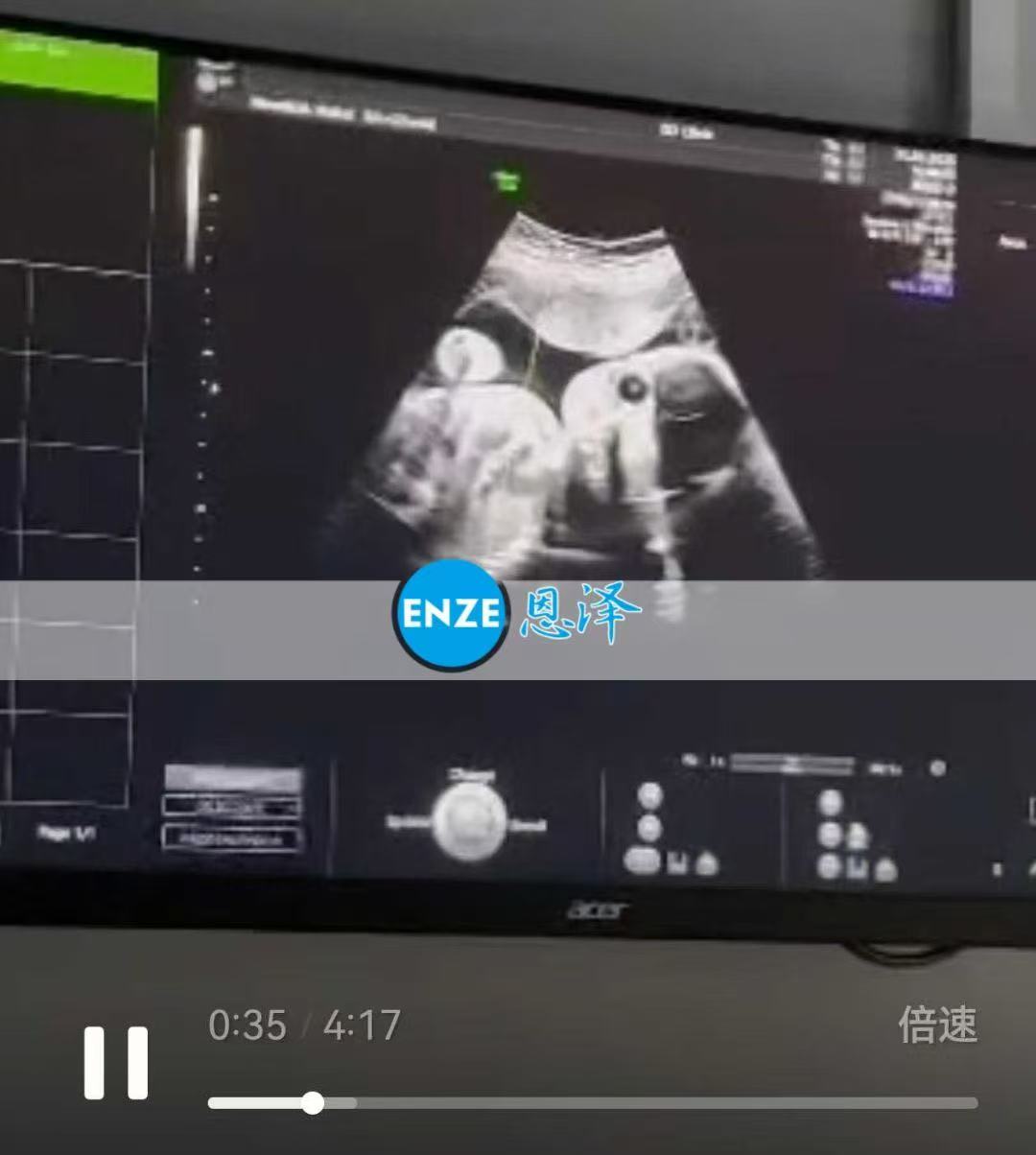 格鲁吉亚试管婴儿助孕爱心使者26周产检顺利通过