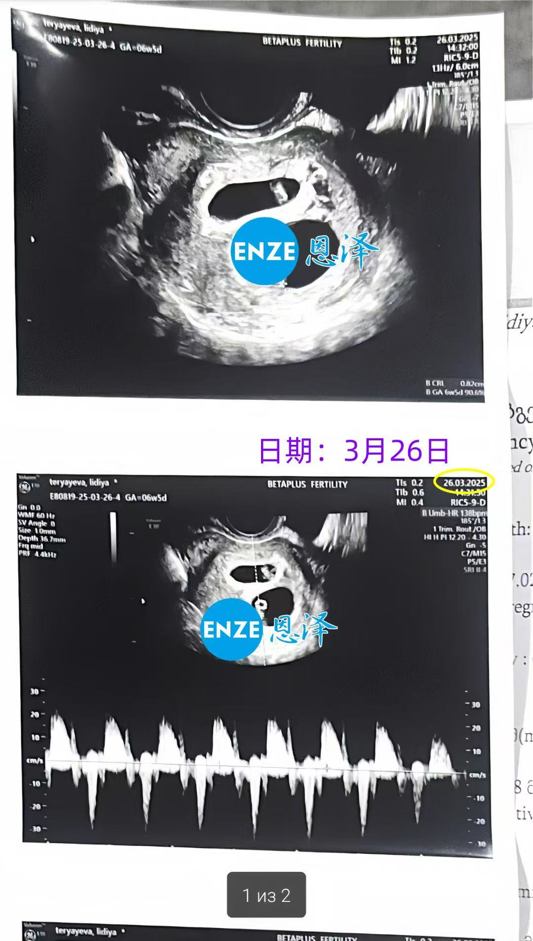 格鲁吉亚试管婴儿助孕爱心使者喜获双胎