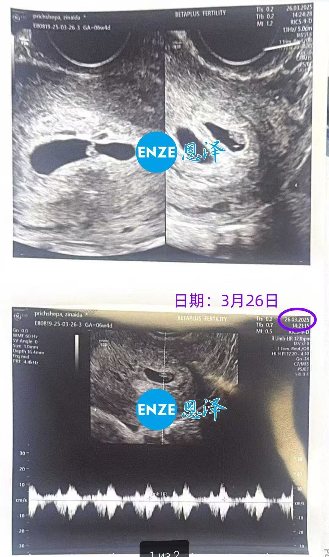 格鲁吉亚试管婴儿助孕爱心使者成功怀上双胎