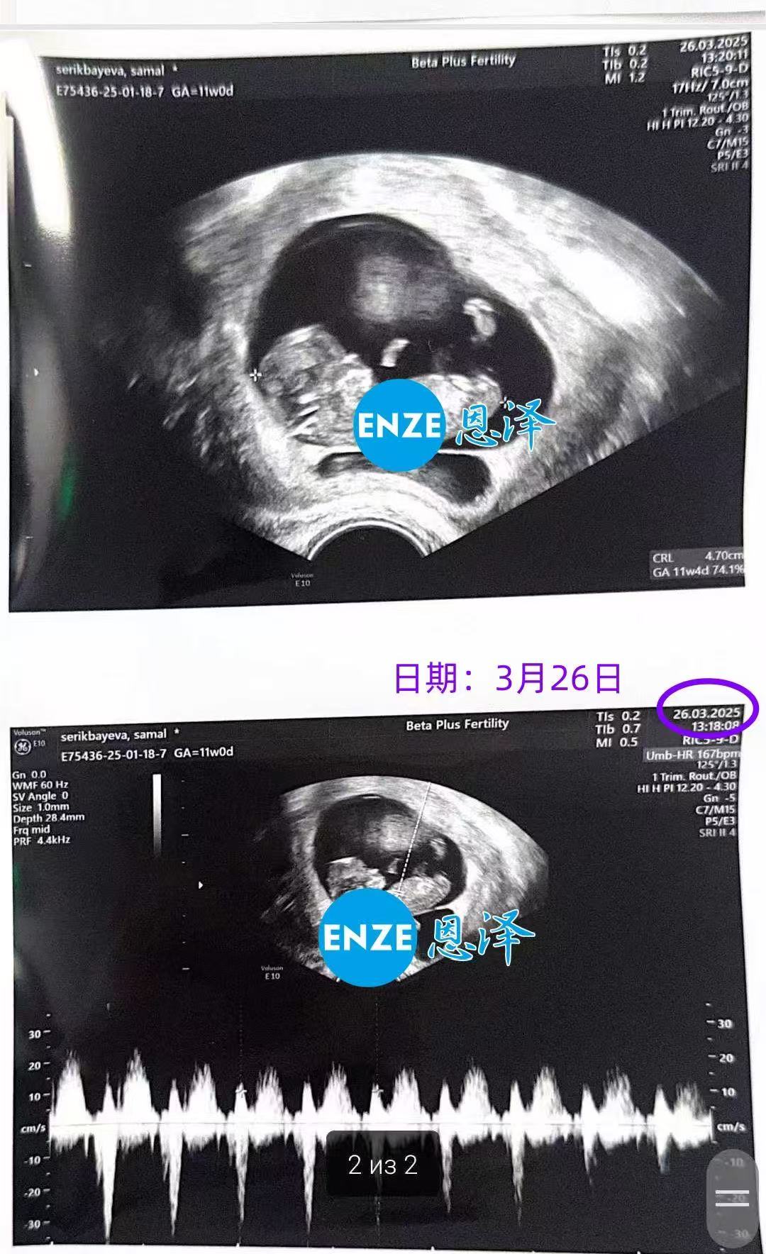 格鲁吉亚试管婴儿助孕爱心使者11周产检顺利过关