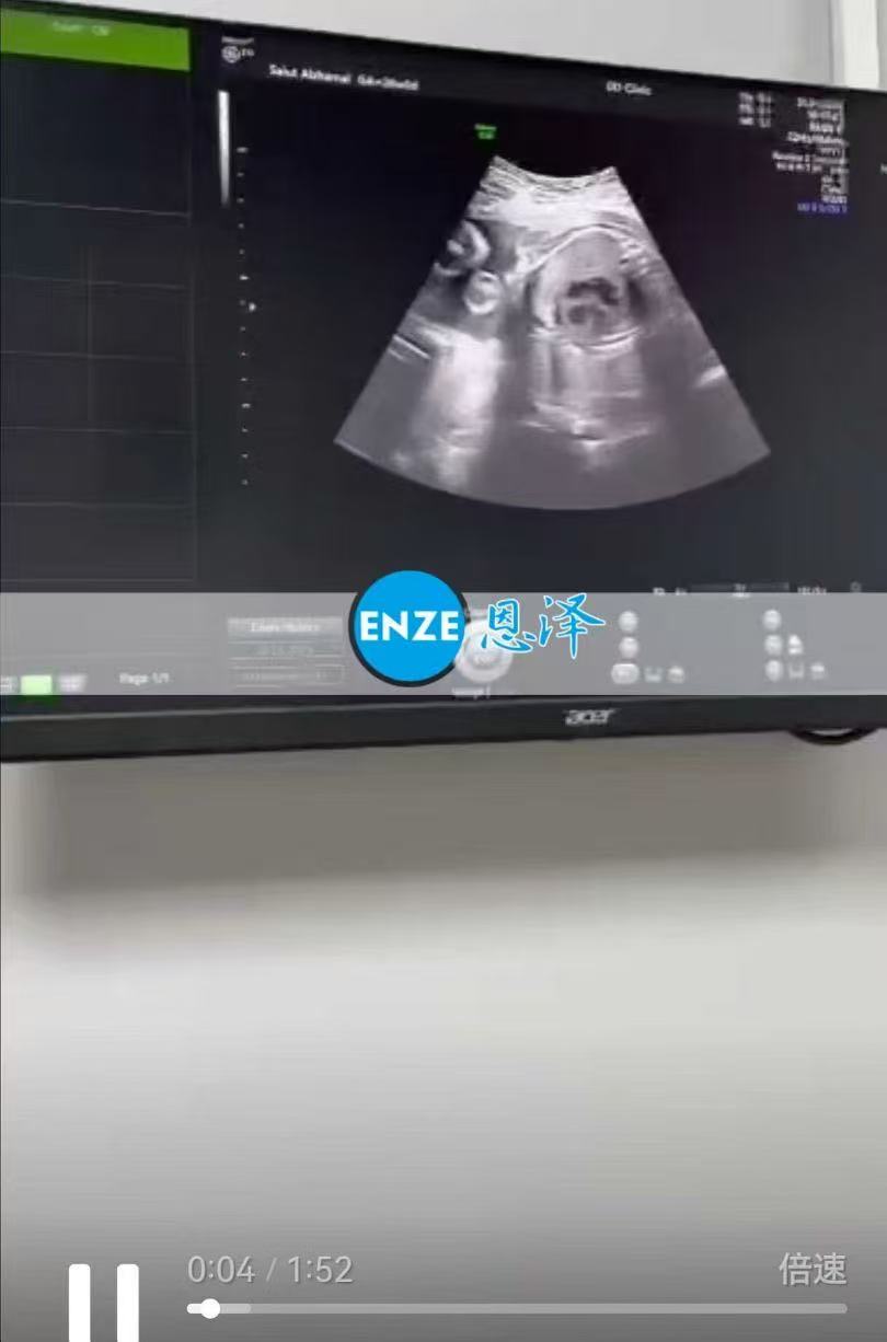 格鲁吉亚试管婴儿助孕爱心使者成功通过25周产检