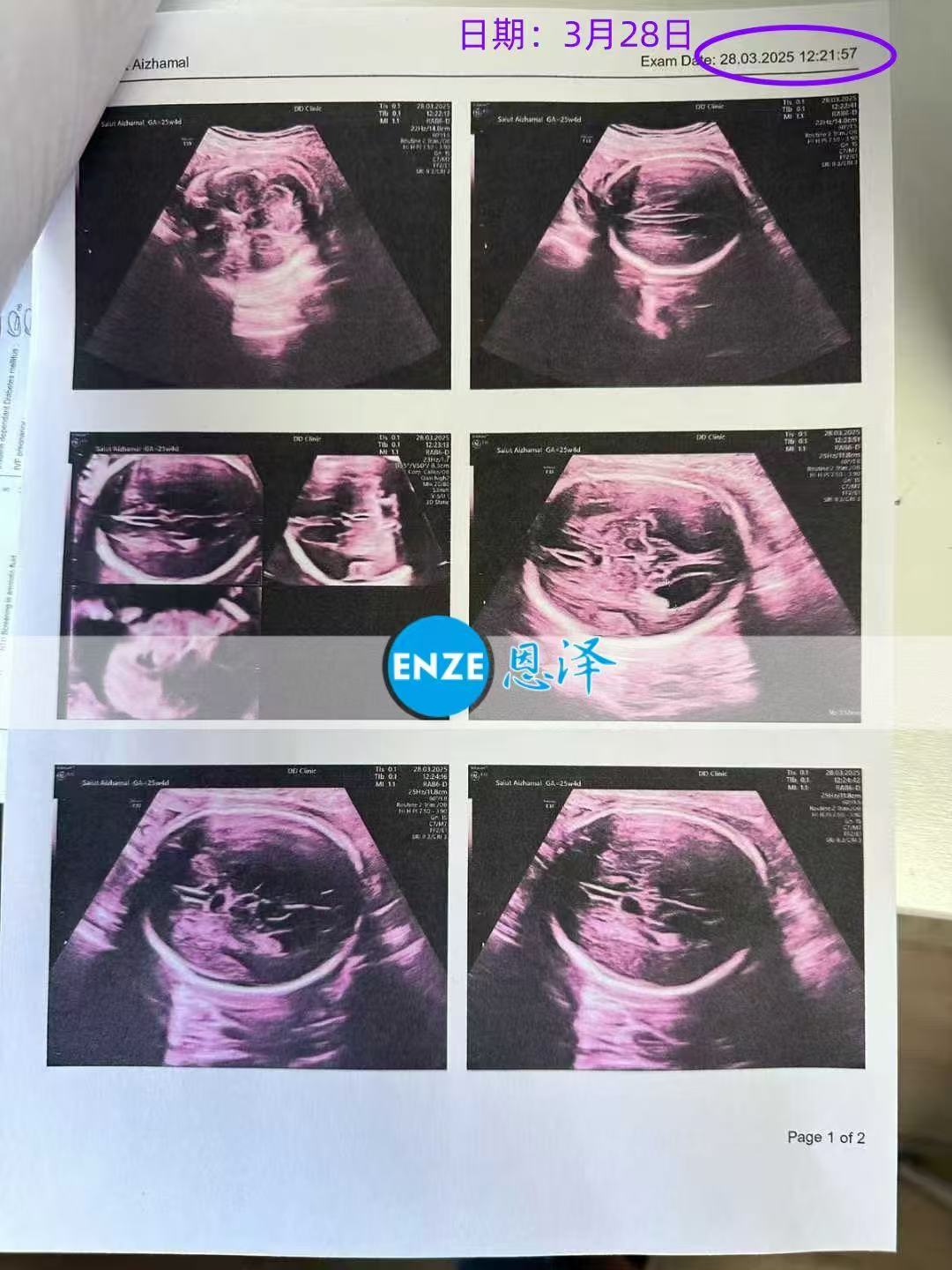 格鲁吉亚试管婴儿助孕爱心使者成功通过25周产检
