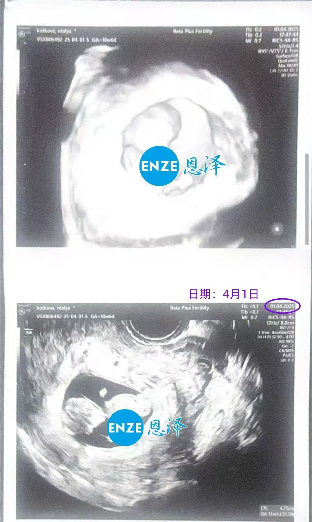 格鲁吉亚试管婴儿助孕爱心使者11周产检顺利过关
