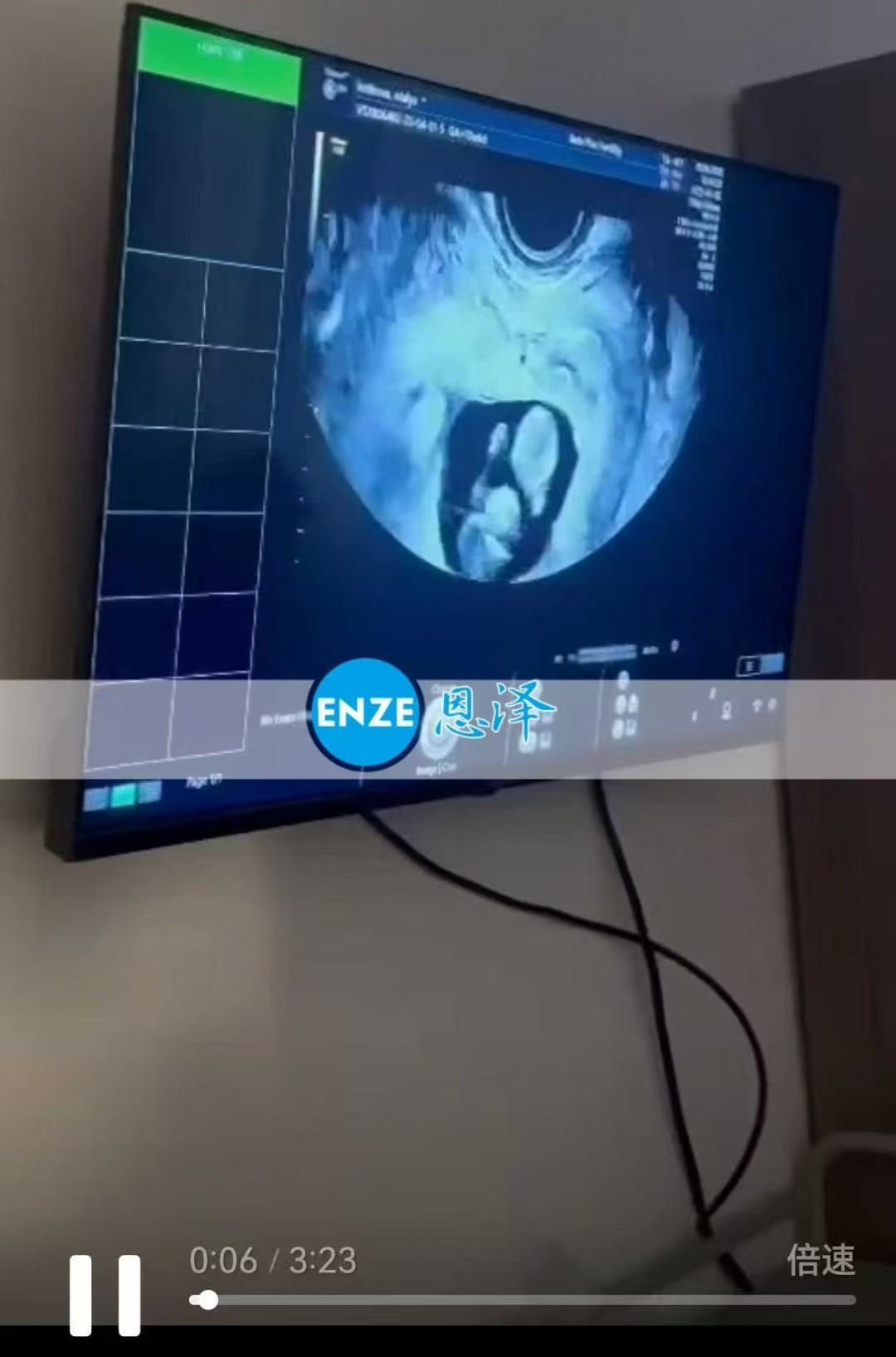 格鲁吉亚试管婴儿助孕爱心使者11周产检顺利过关