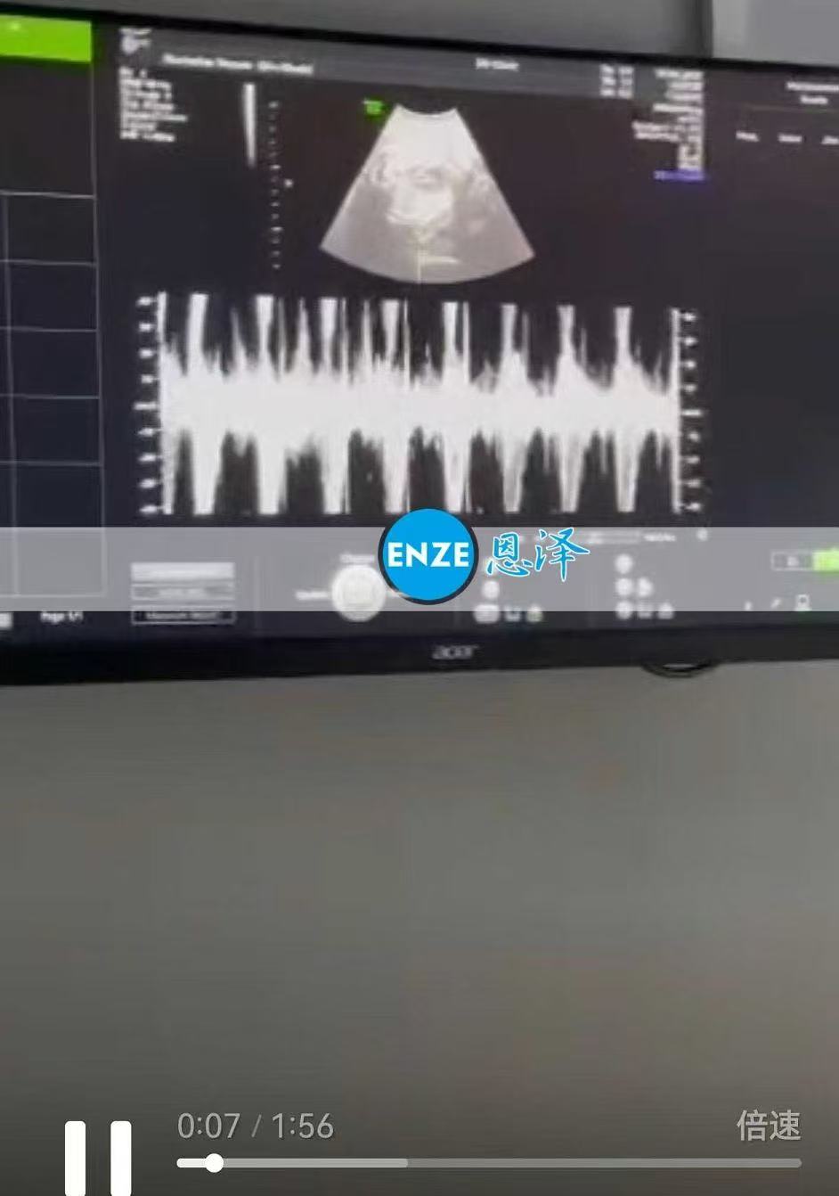格鲁吉亚试管婴儿助孕爱心使者30周产检进展顺利