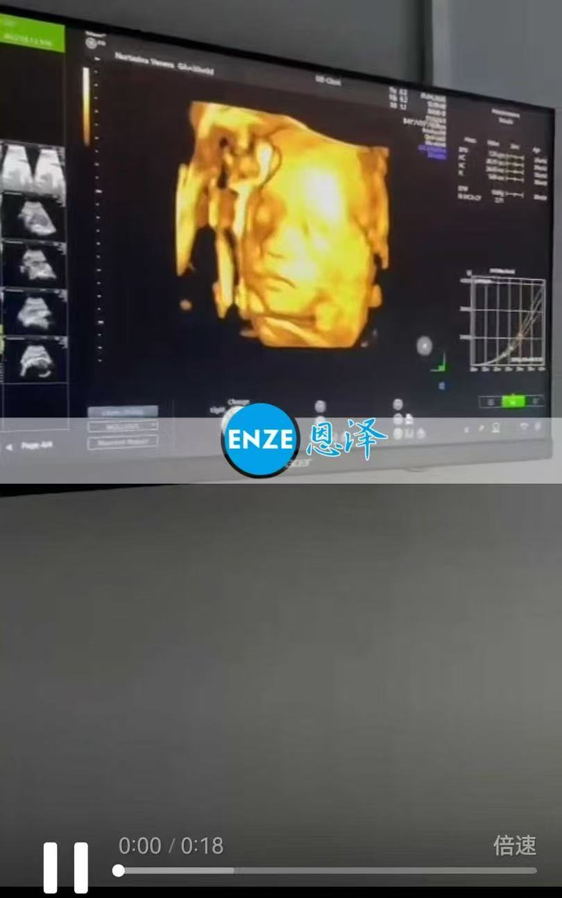 格鲁吉亚试管婴儿助孕爱心使者30周产检进展顺利