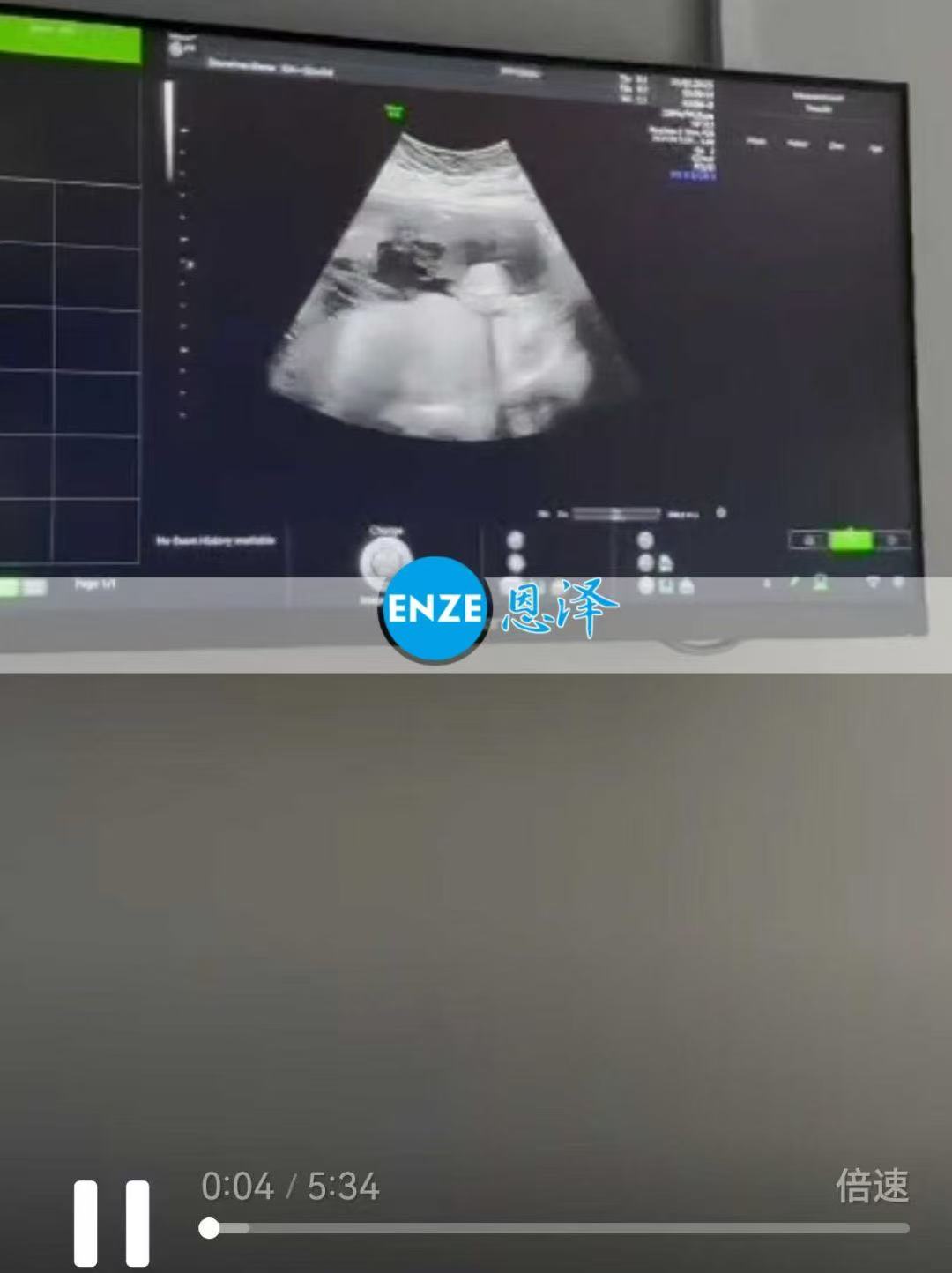 格鲁吉亚试管婴儿助孕爱心使者22周产检顺利通过