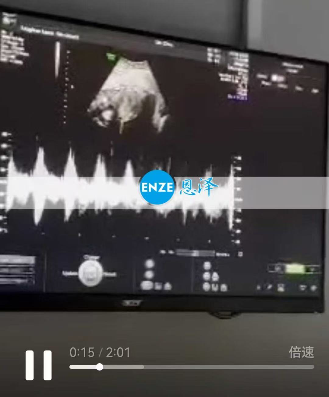 格鲁吉亚试管婴儿助孕爱心使者26周产检顺利通过