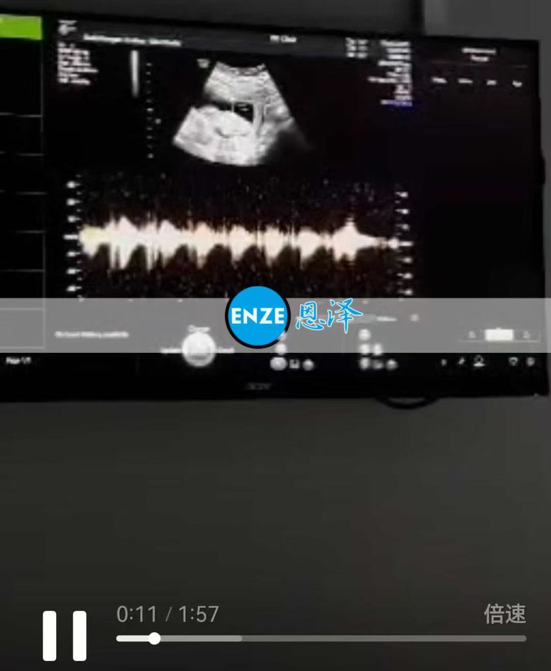 格鲁吉亚试管婴儿助孕爱心使者13周产检成功利通过