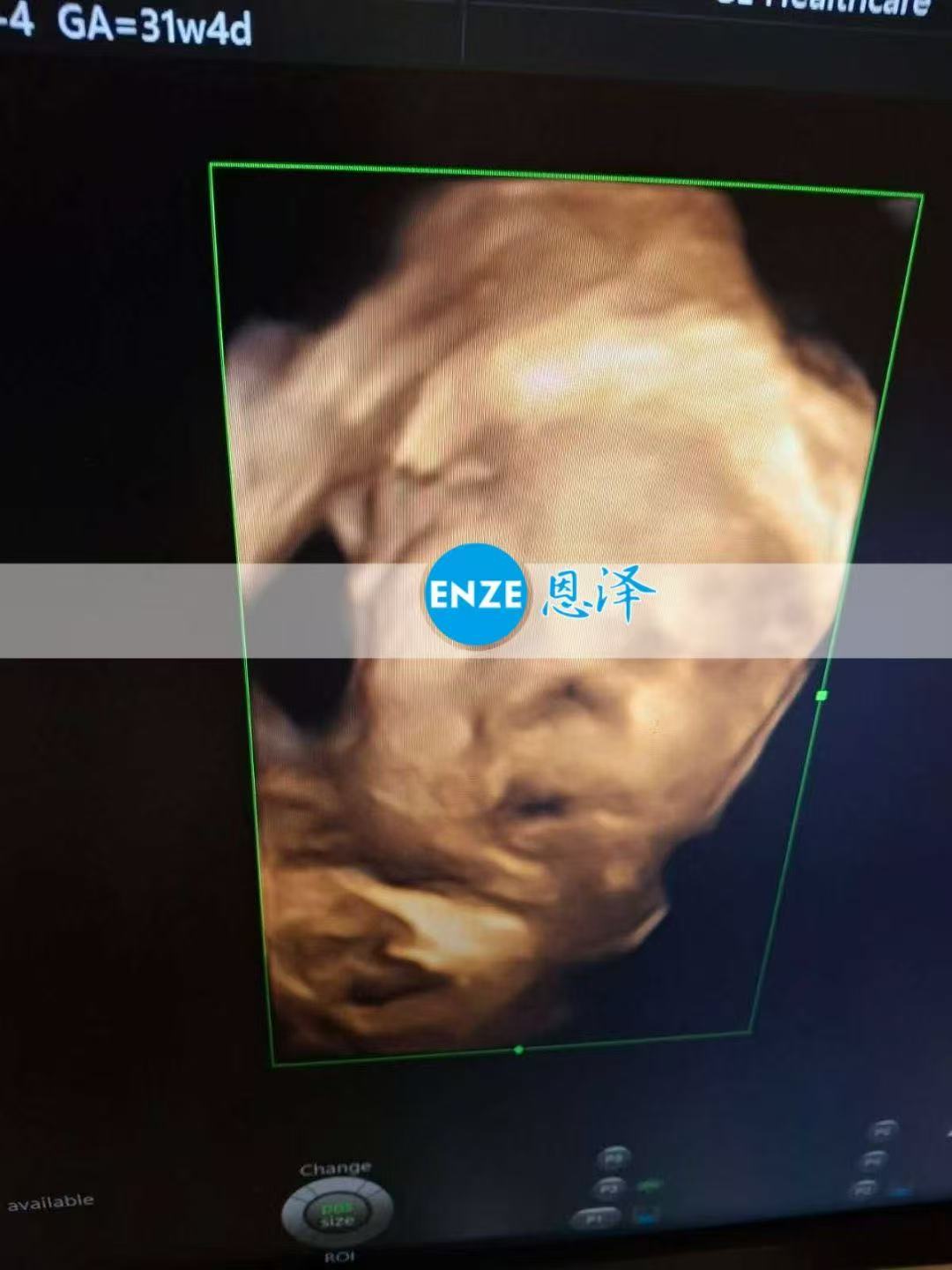 格鲁吉亚试管婴儿助孕爱心使者31周产检顺利通过