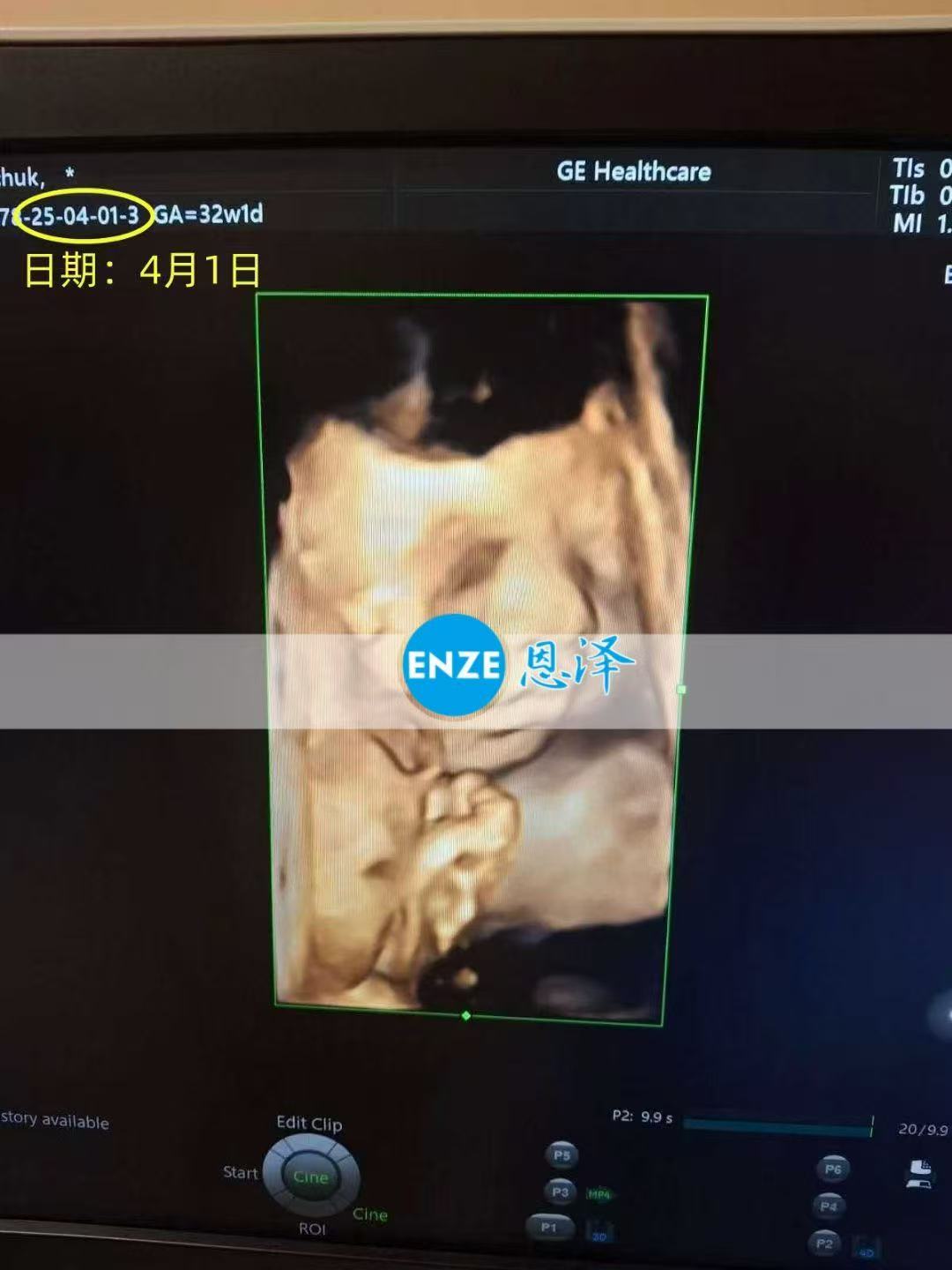 乌克兰试管婴儿助孕爱心使者32周产检顺利通过