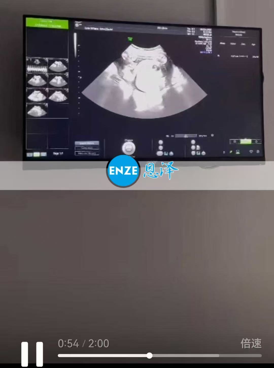 格鲁吉亚试管婴儿助孕爱心使者顺利通过25周产检